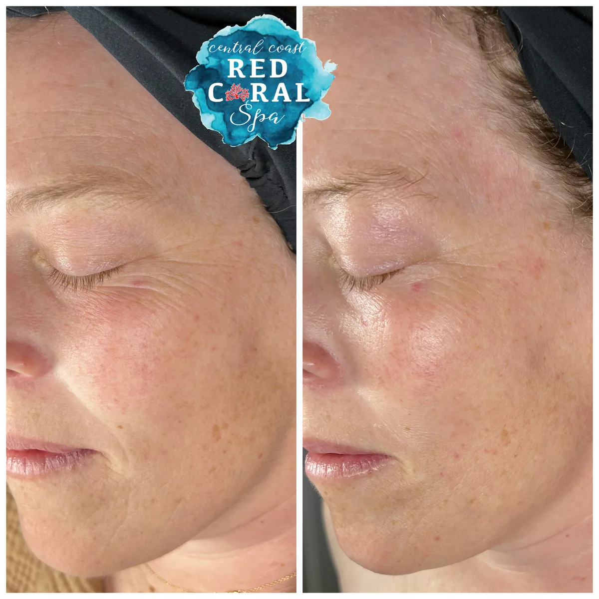 Before and after Facial Sculpting with Buccal Therapy results