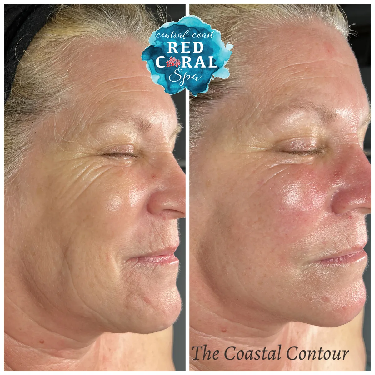 Facial Sculpting with Buccal Therapy in progress