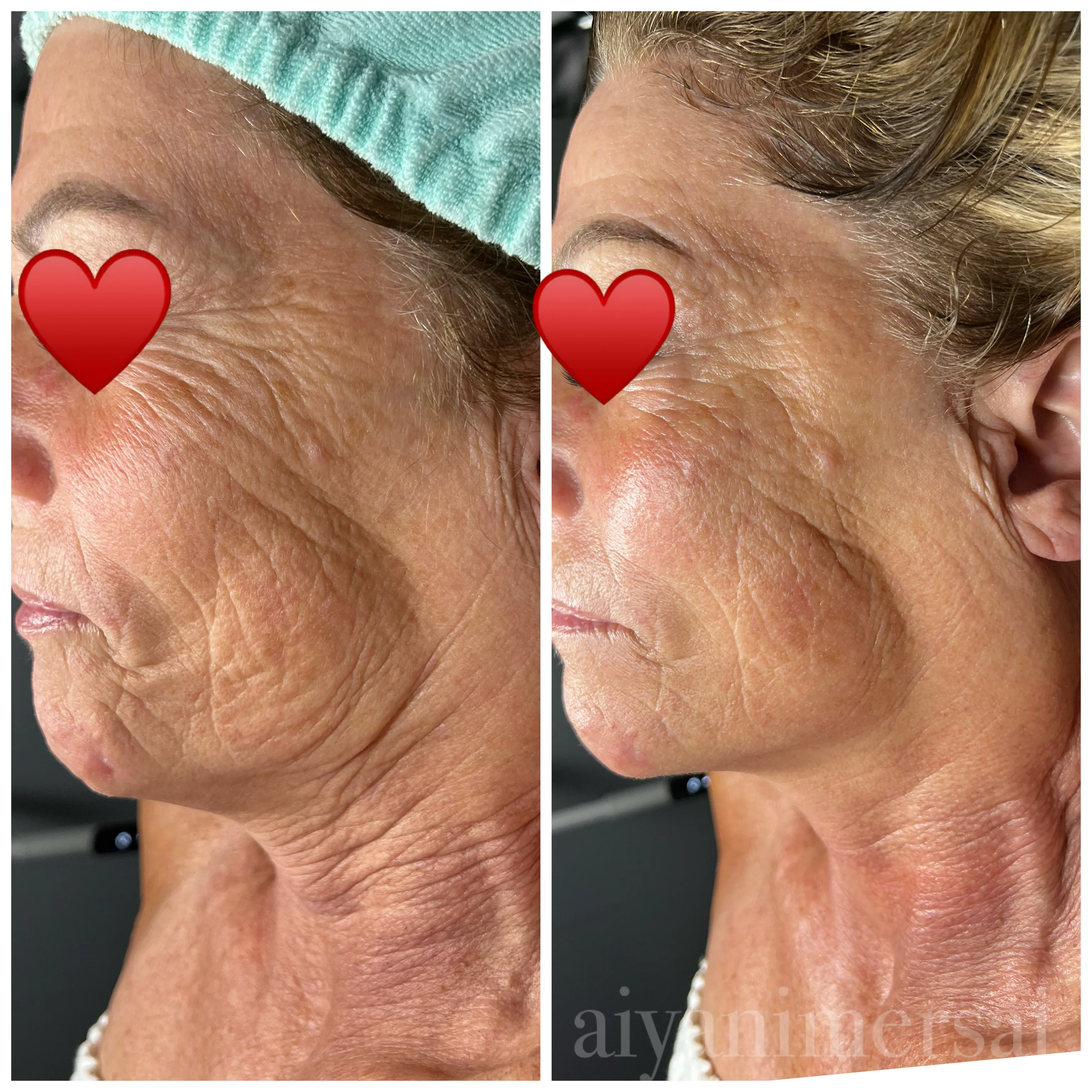 Before and after Microcurrent results — jaw and neck wrinkle reduction