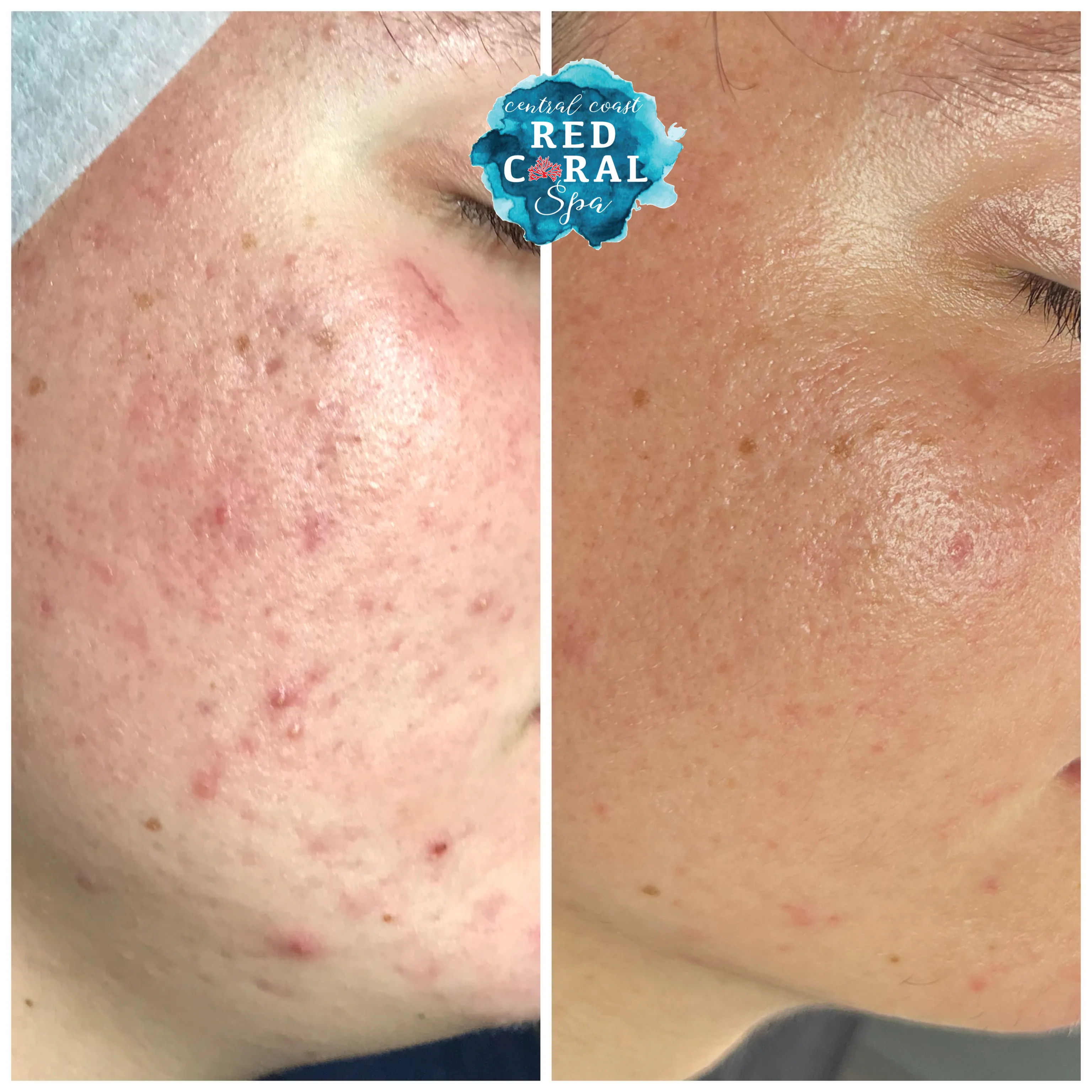 Before and after facial treatment results