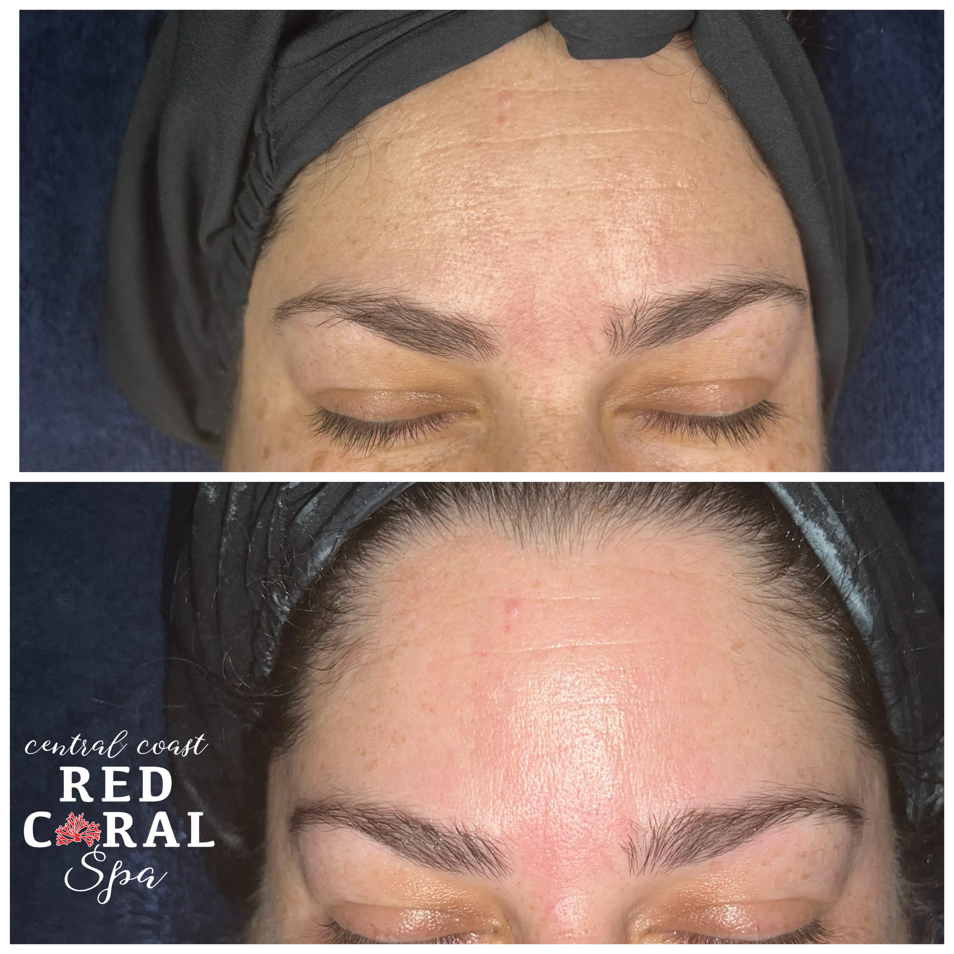 Before and after facial treatment results
