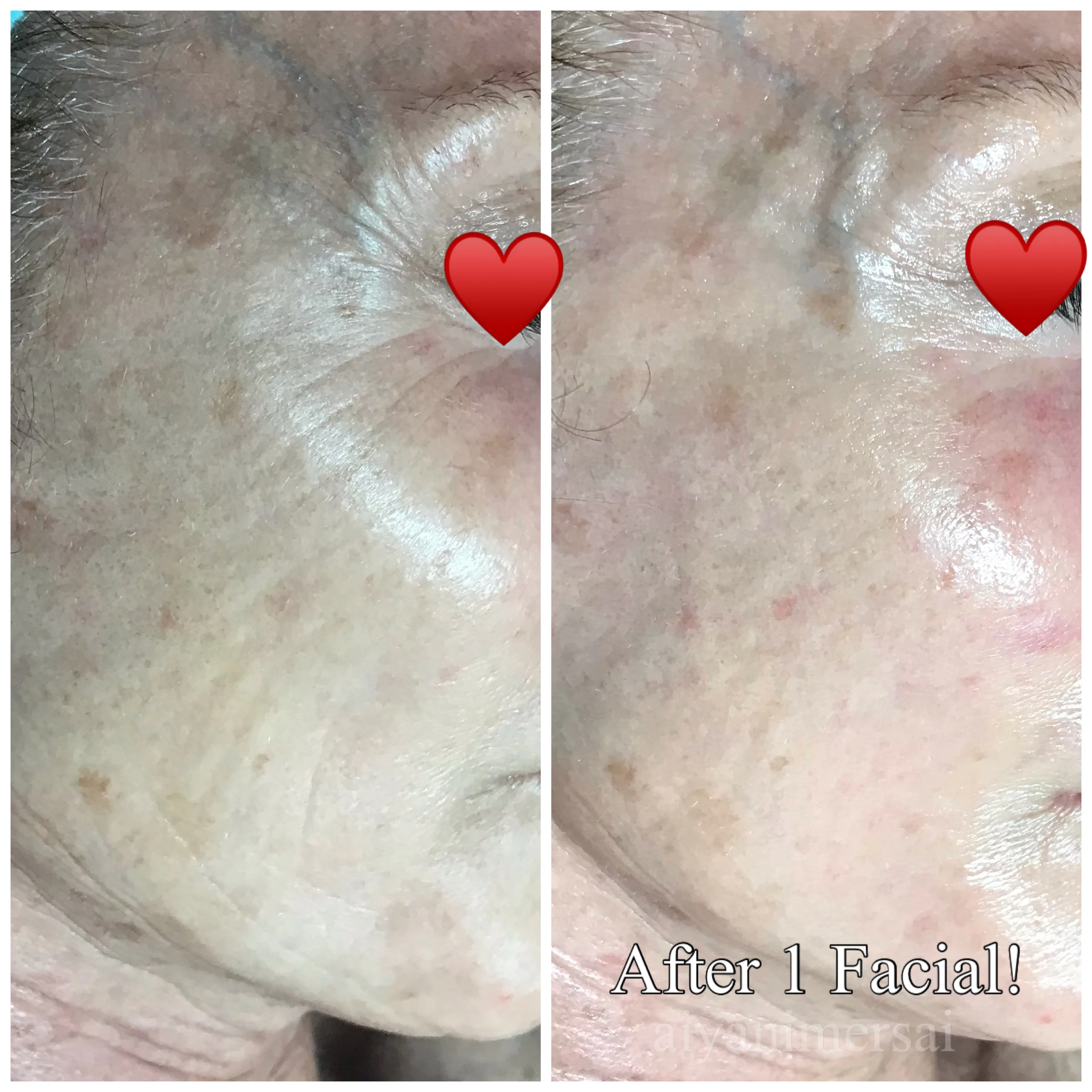 Before and after skin care results