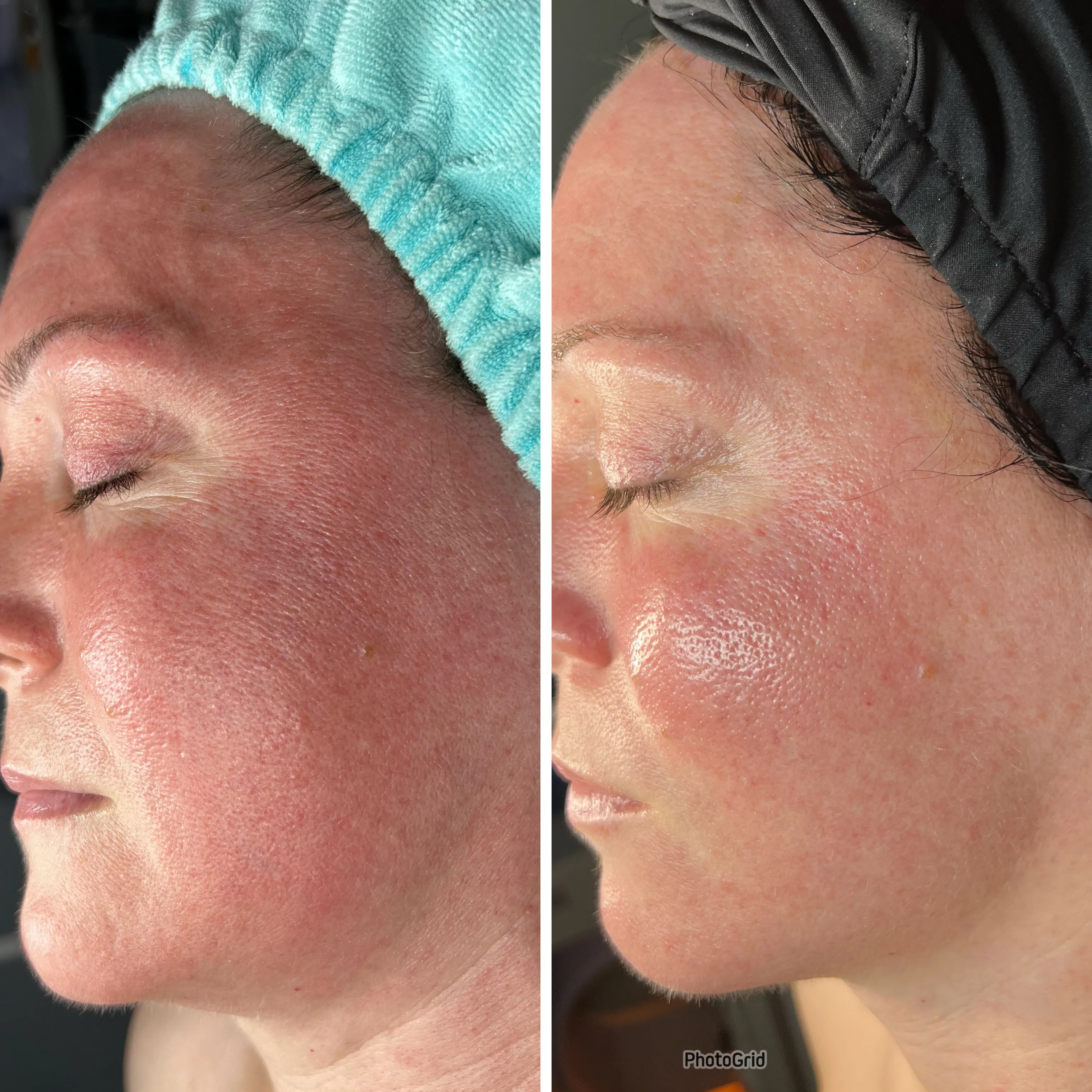 Before and after skin care results