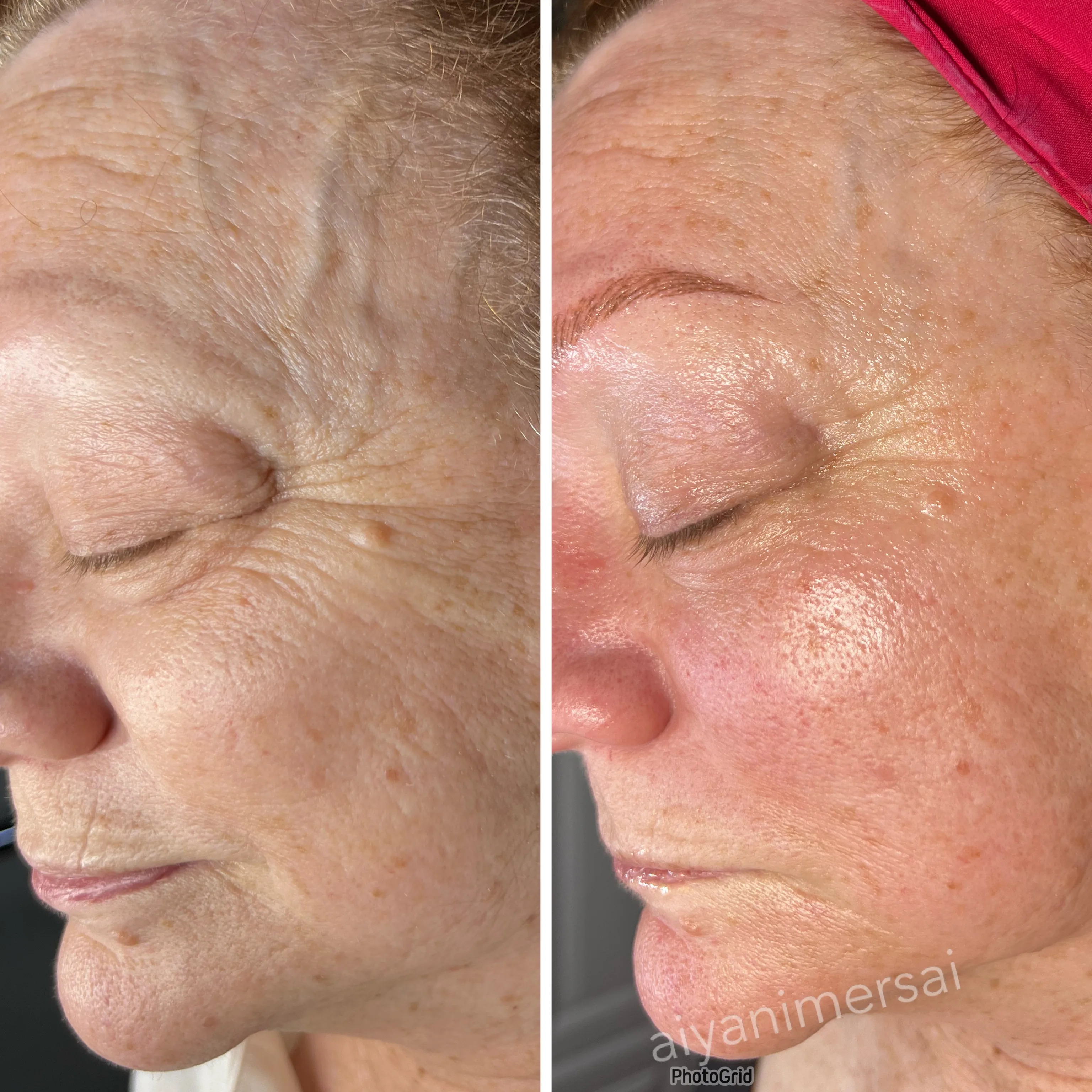 Before and after skin care results