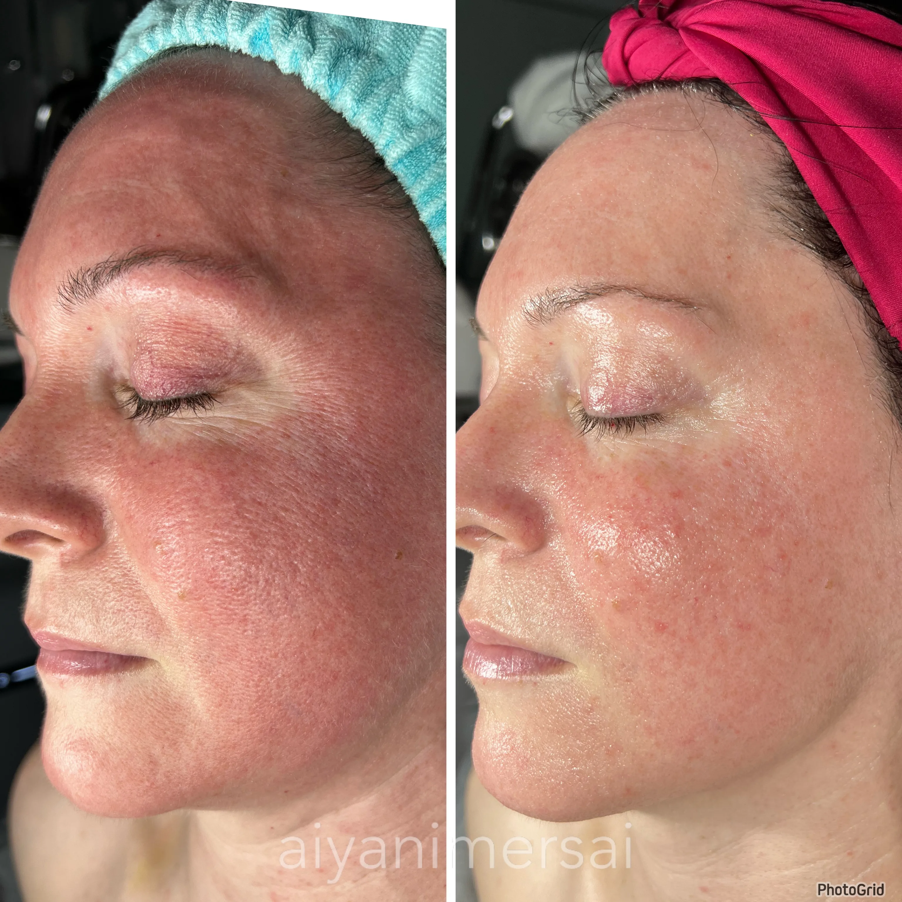 Before and after skin care results