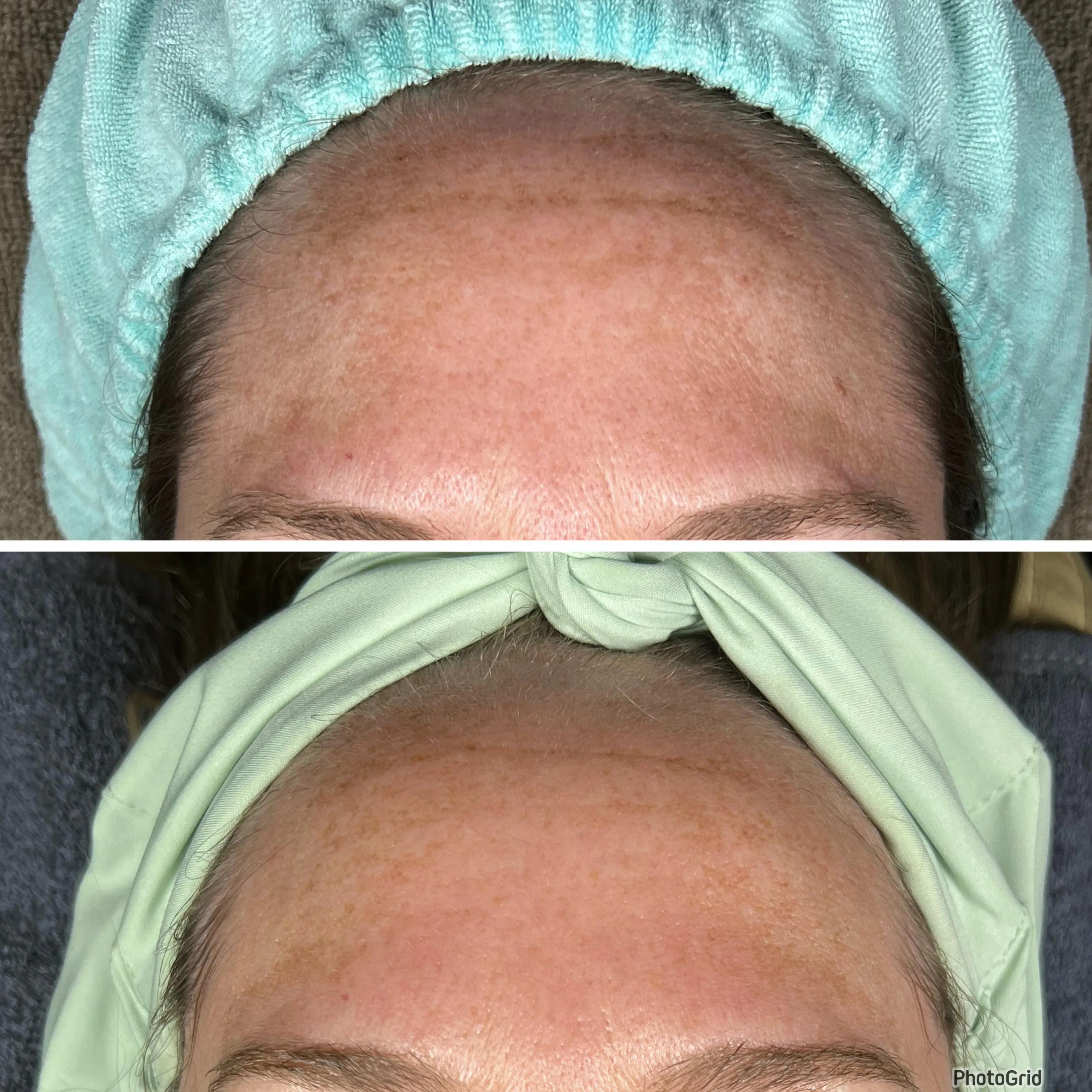 Before and after skin care results