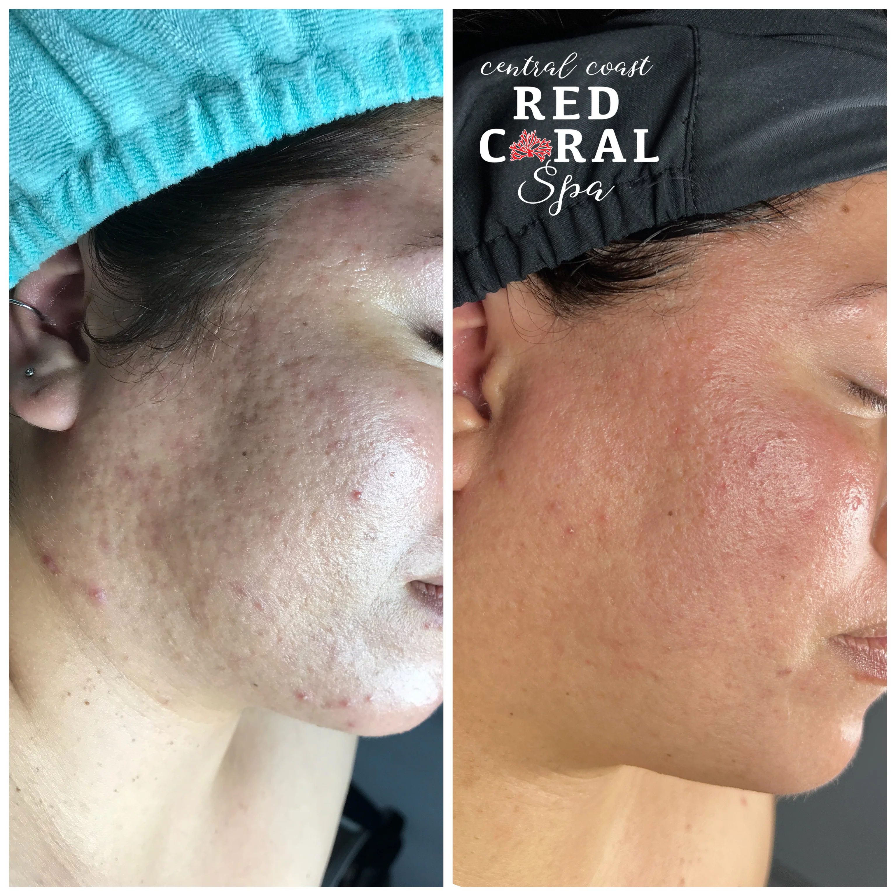 Karina — before and after skin care results, acne cleared over two years of treatment