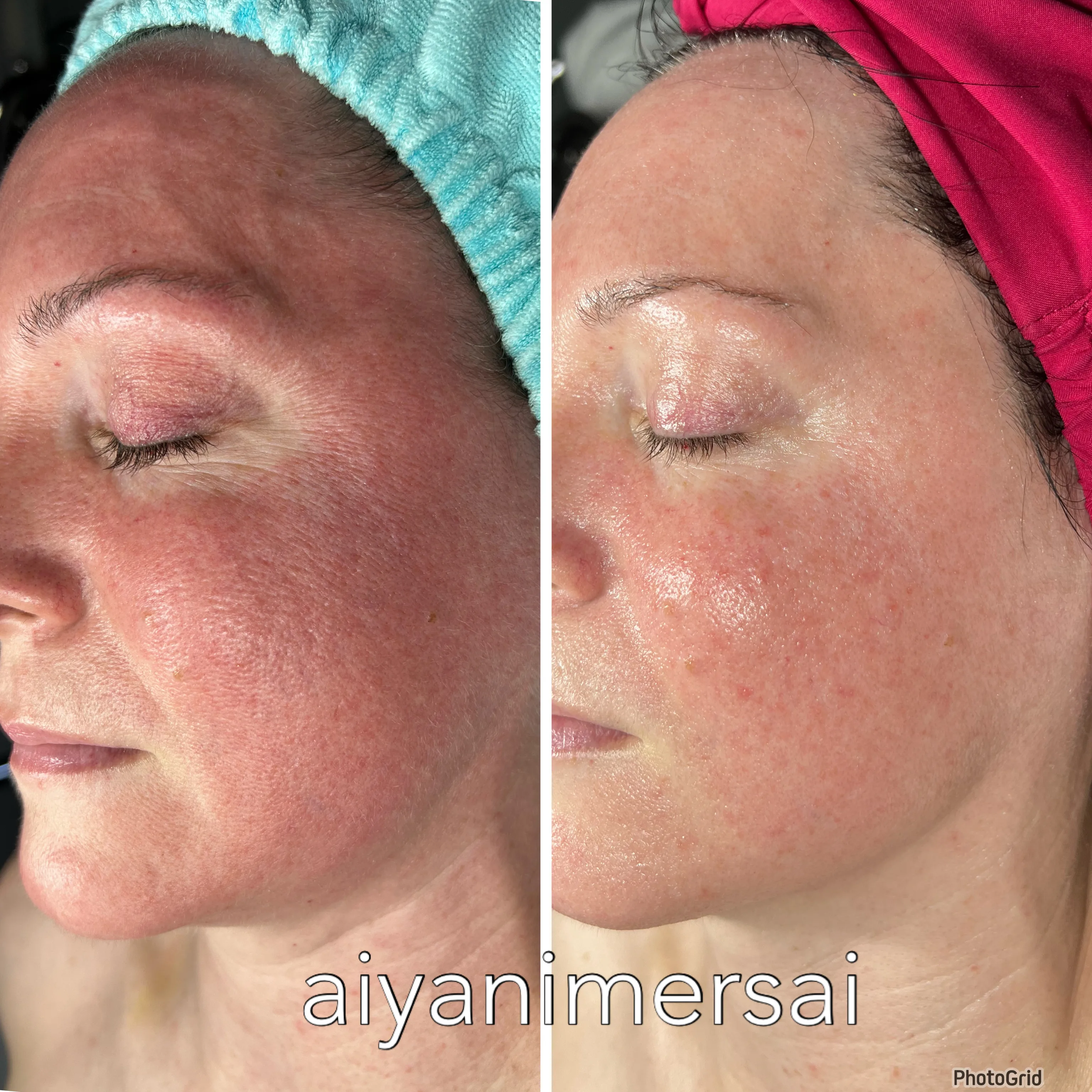 Before and after skin care results