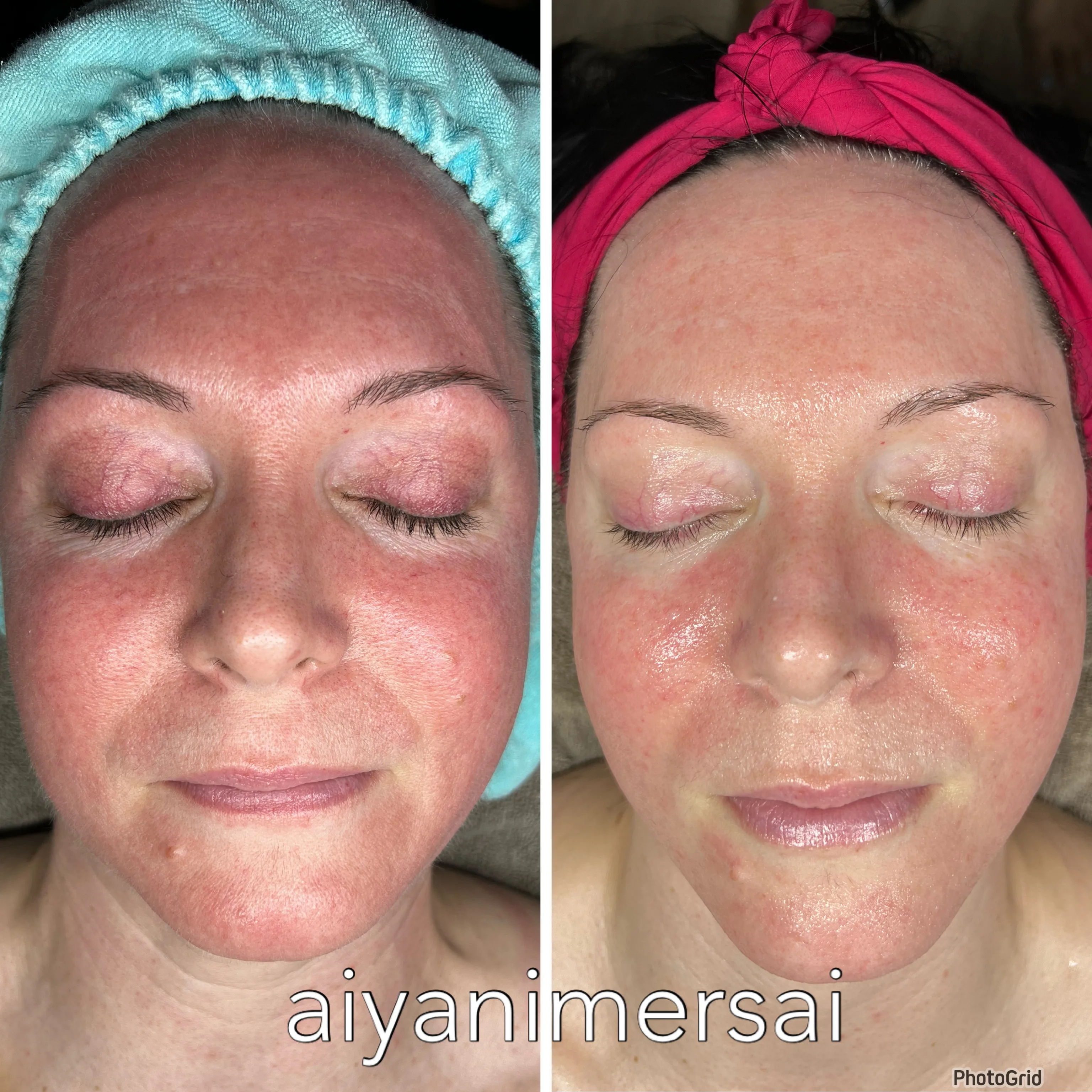 Before and after skin care results