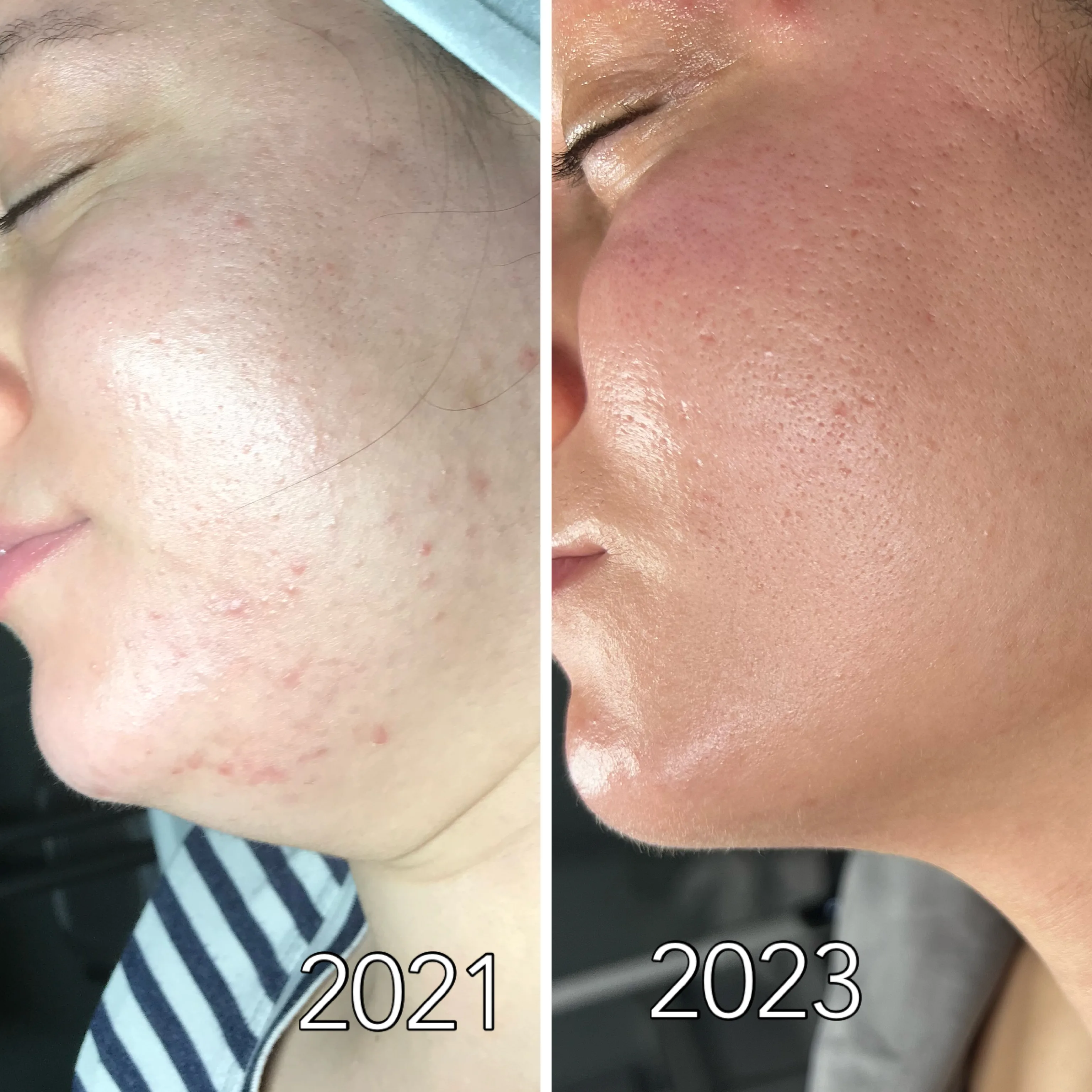 Before and after skin care results