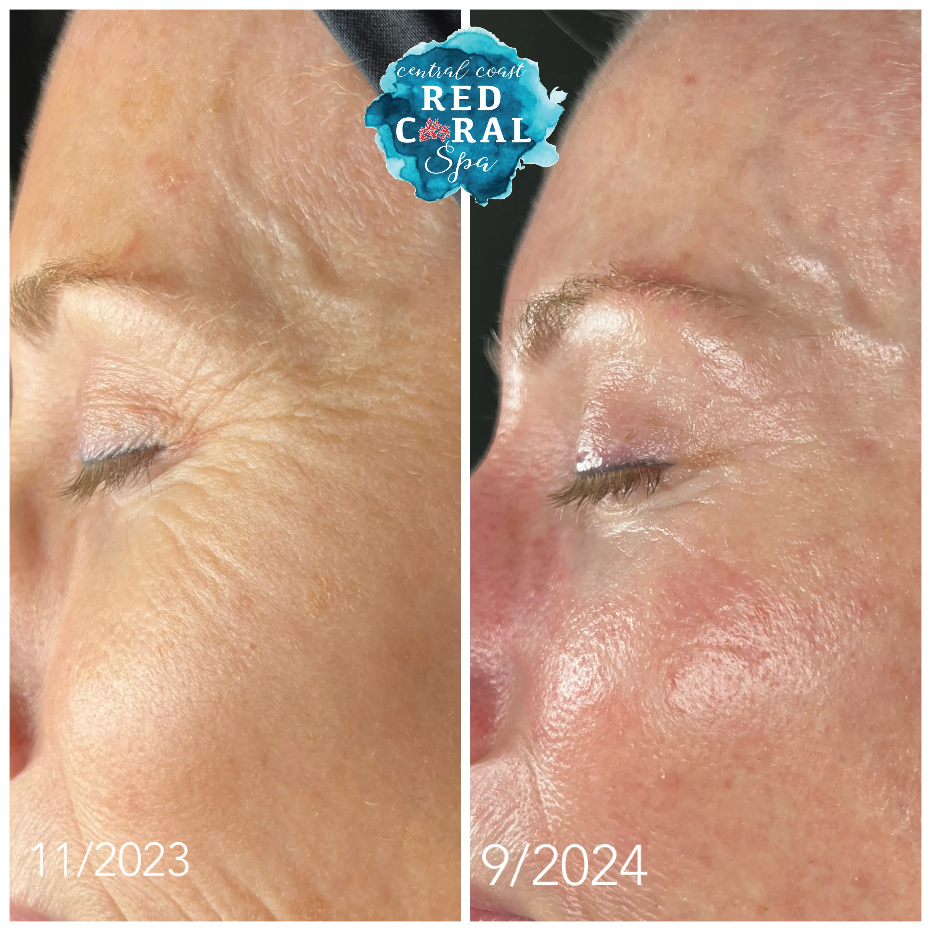 Before and after skin care results