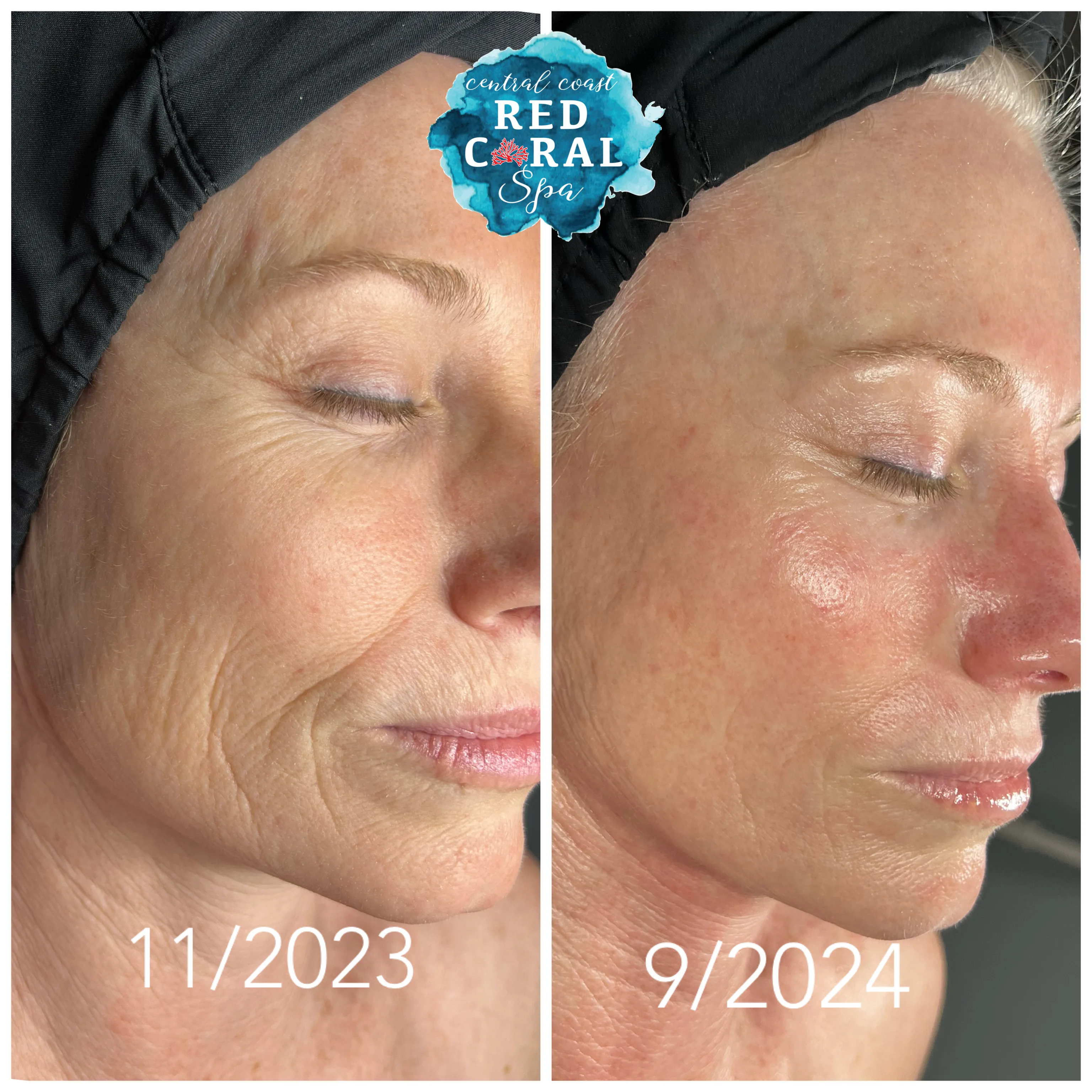 Before and after skin care results