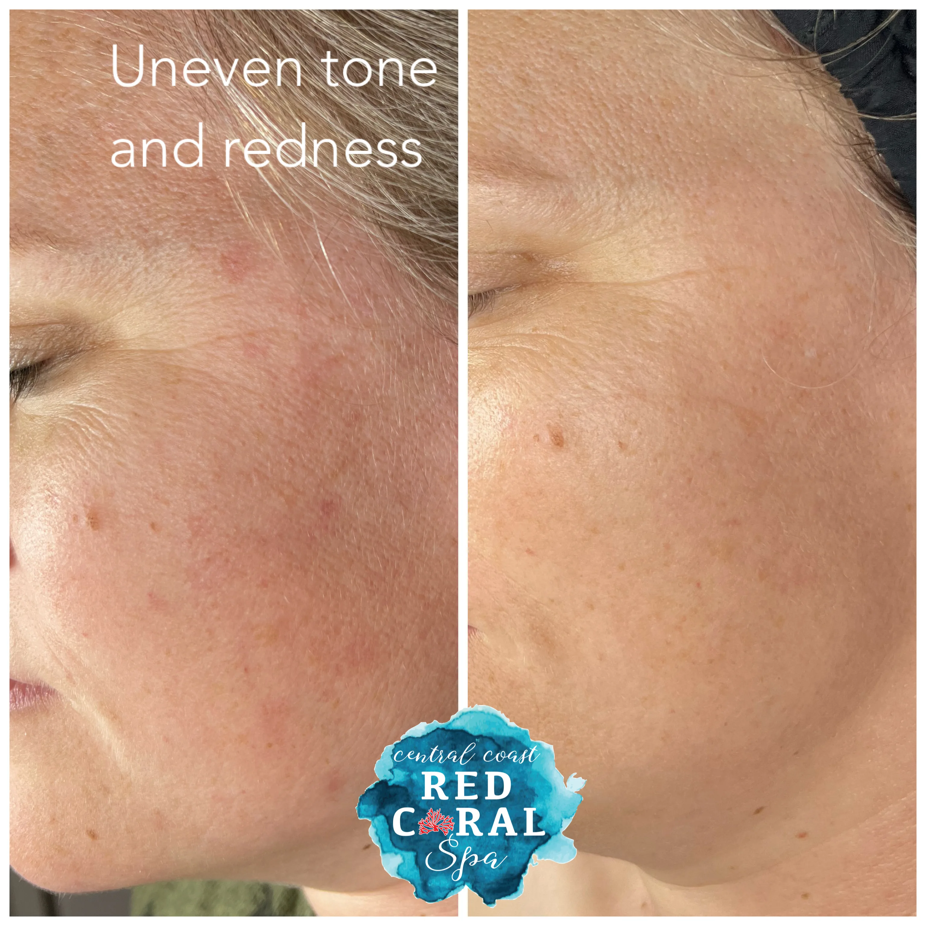 Before and after skin care results