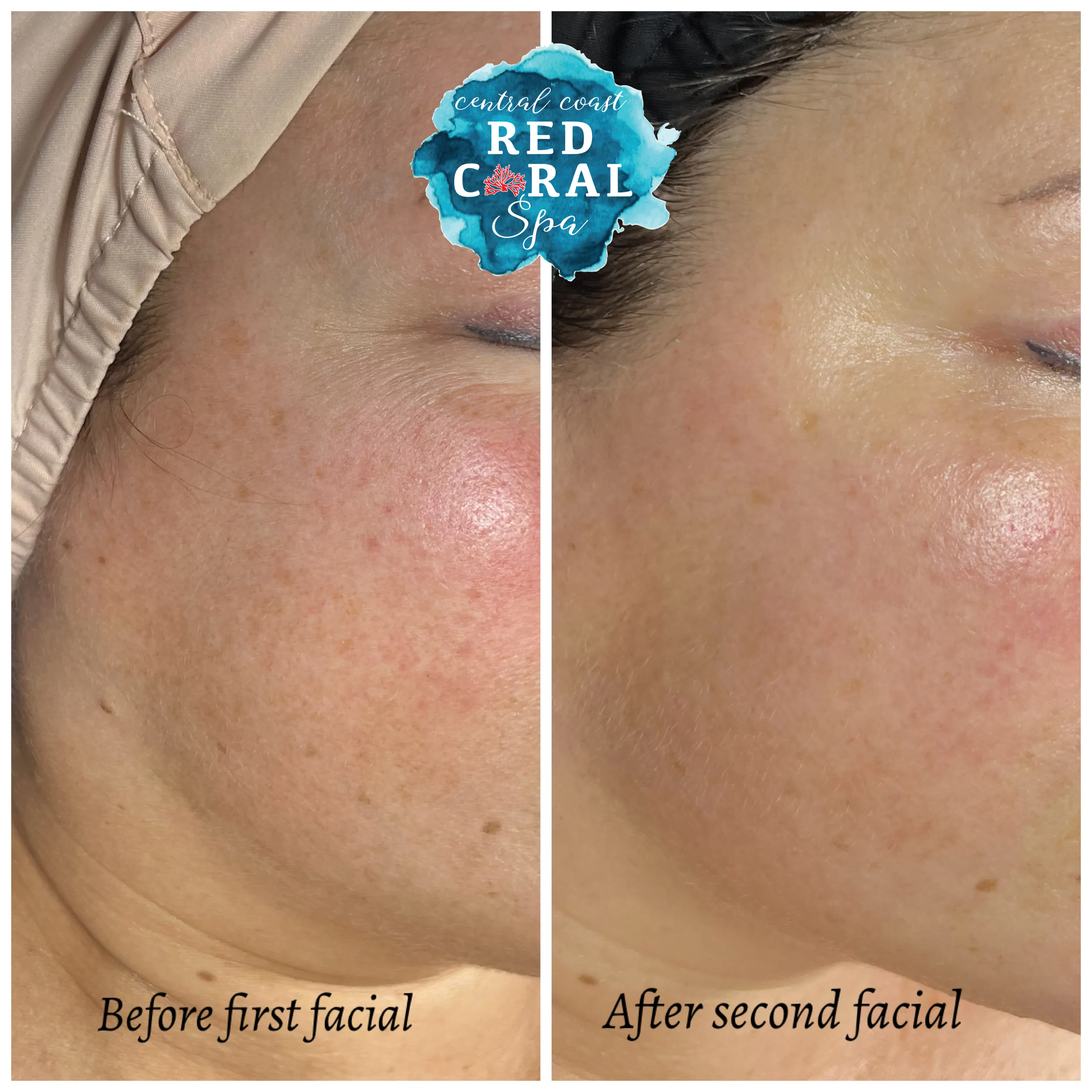 Before and after skin care results