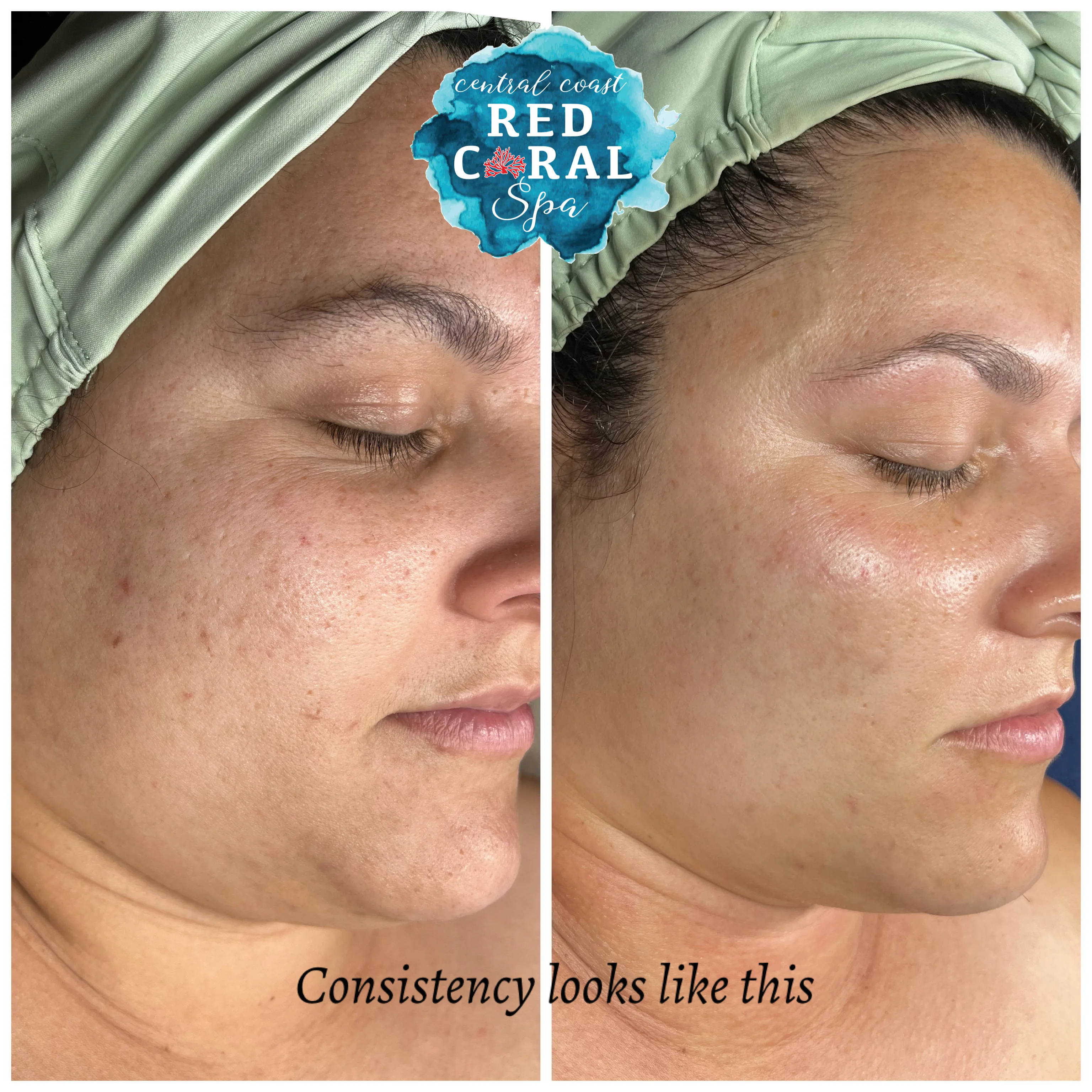 Before and after skin care results