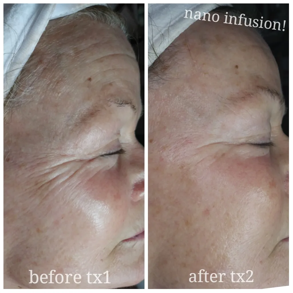 Before and after skin care results