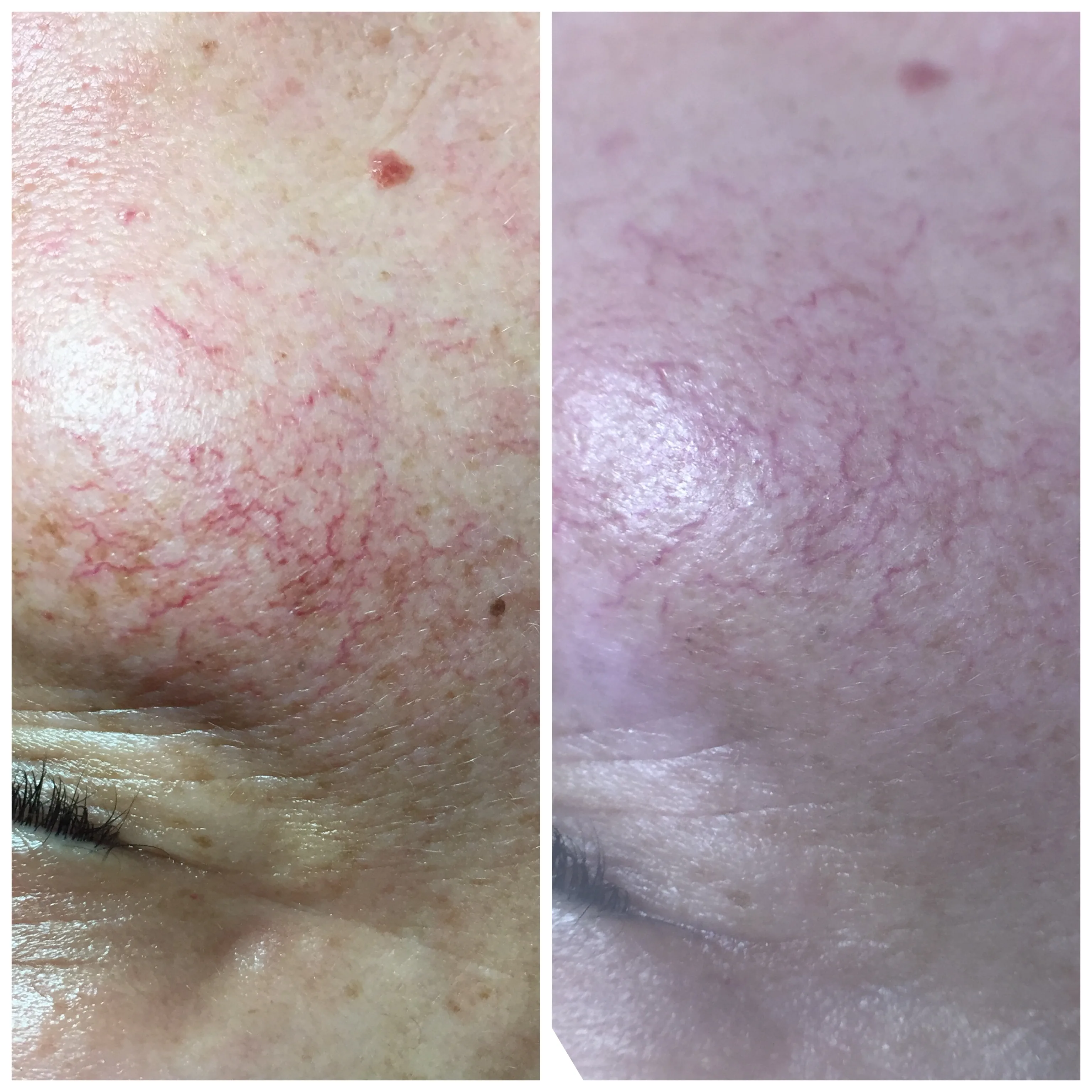 Before and after Skin Sheek treatment — broken capillaries