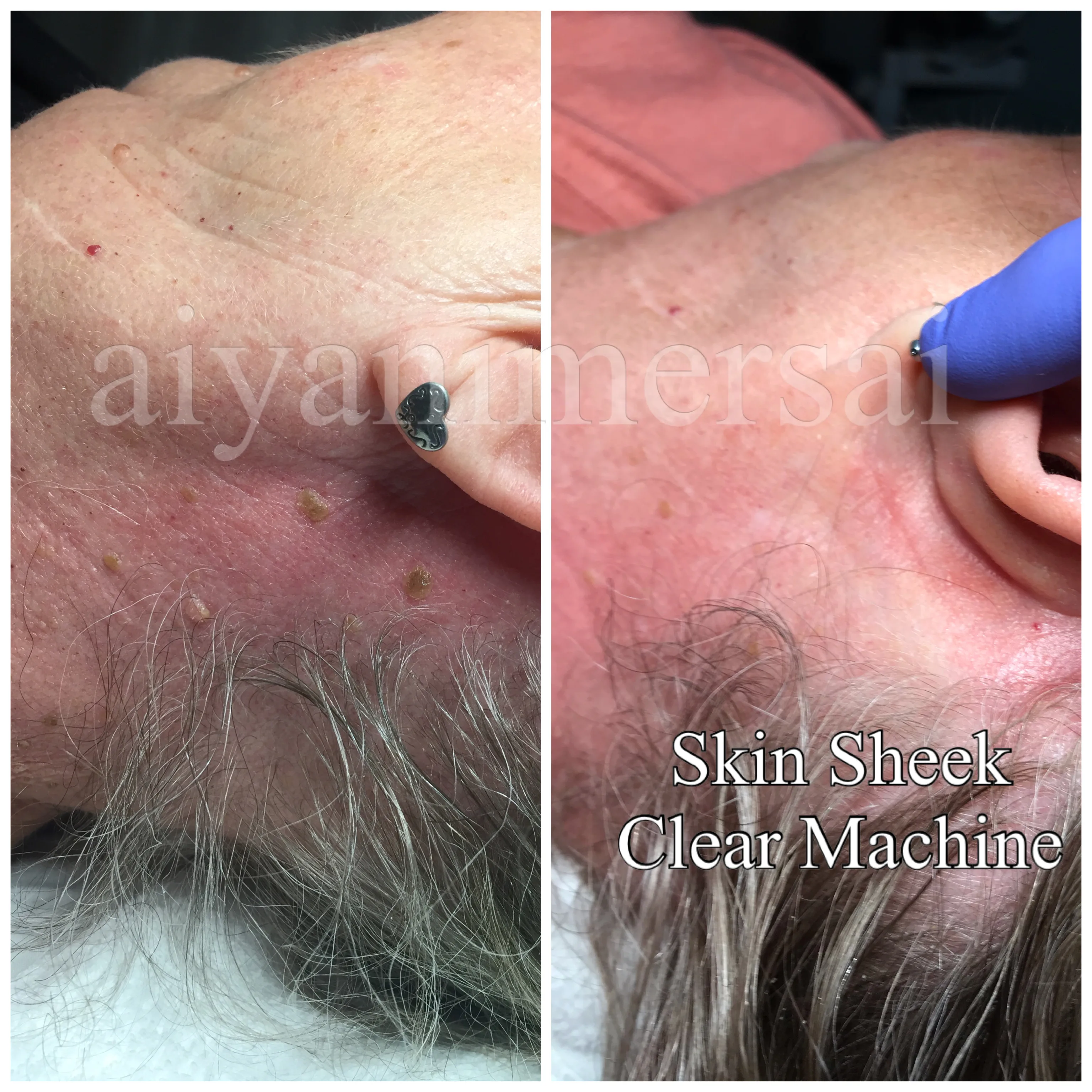 Before and after Skin Sheek treatment results
