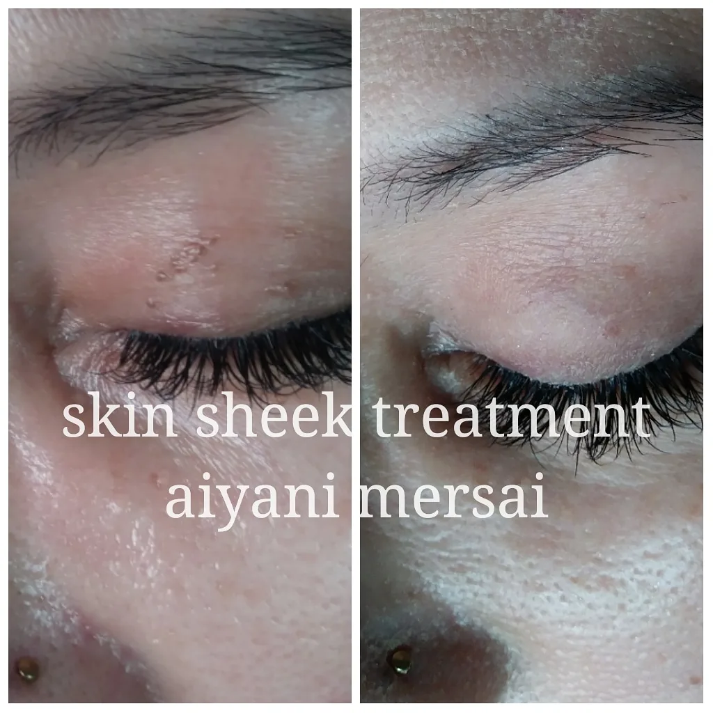 Before and after Skin Sheek treatment results