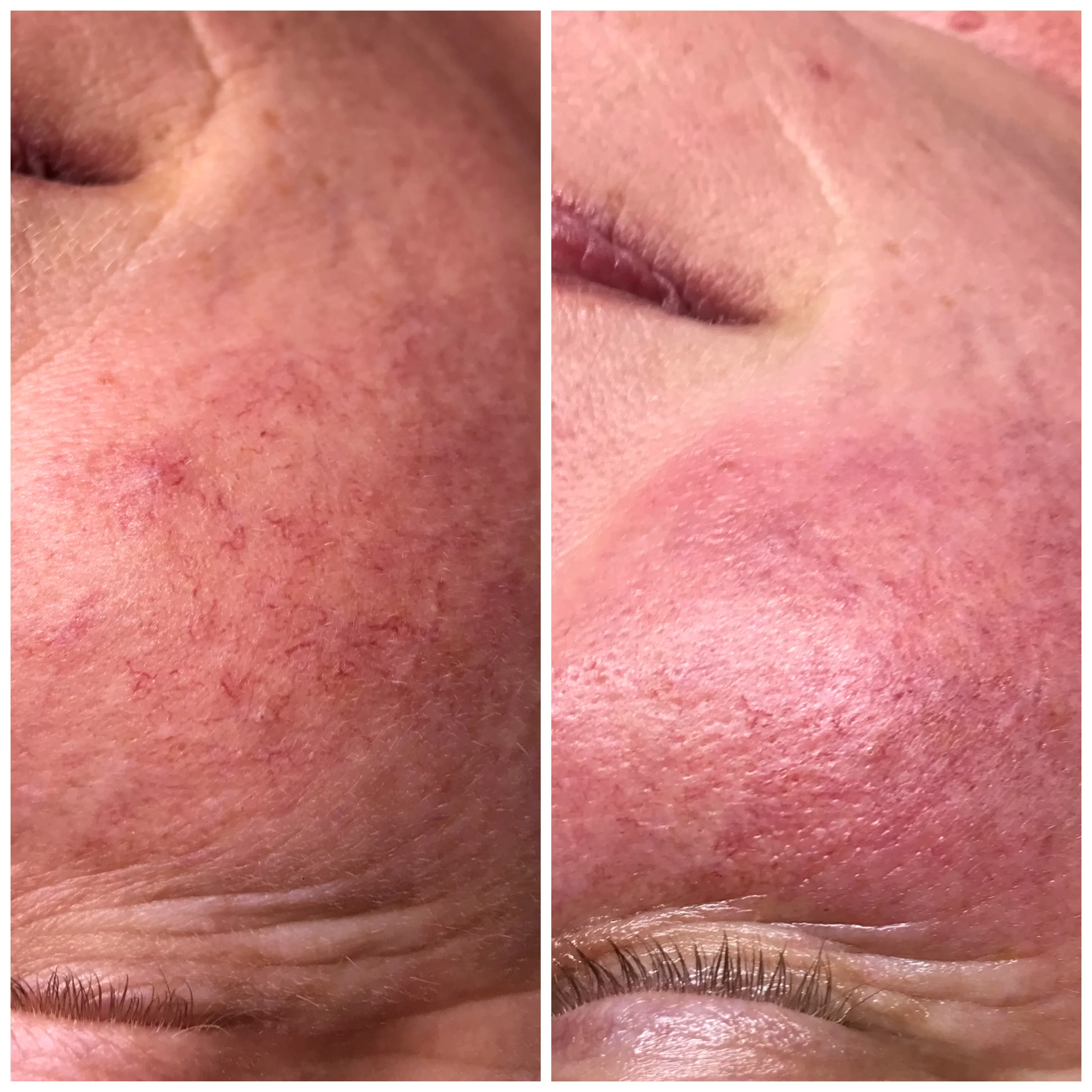 Before and after Skin Sheek treatment results