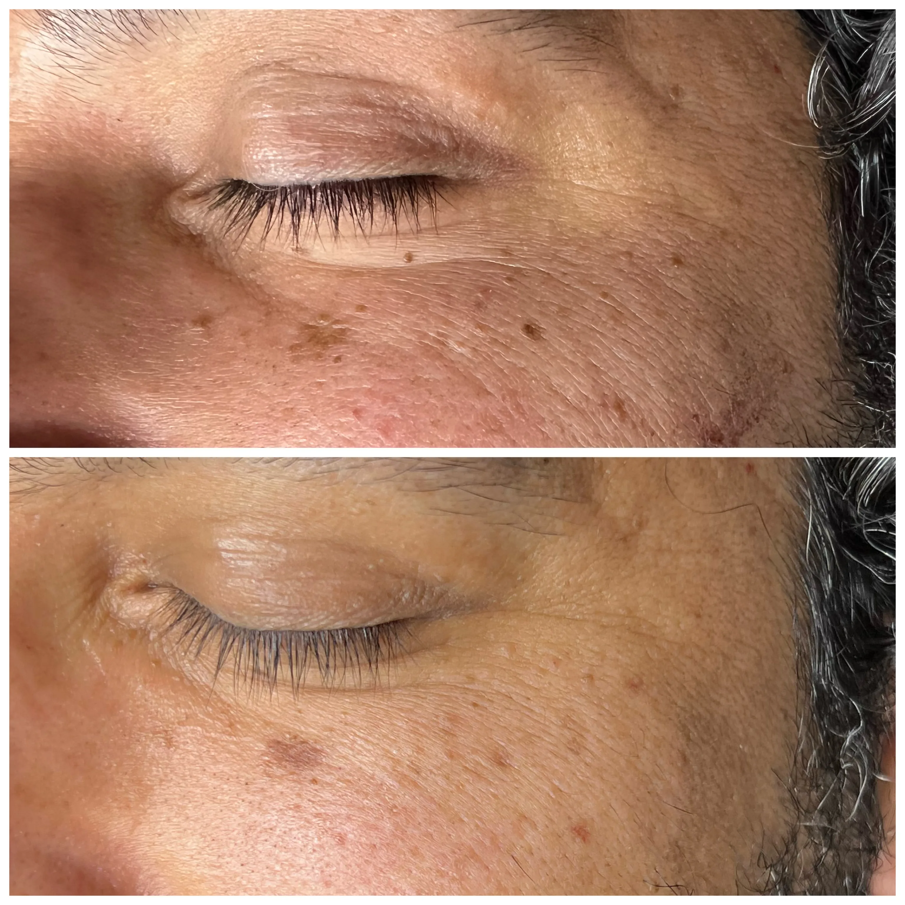 Before and after Skin Sheek treatment results