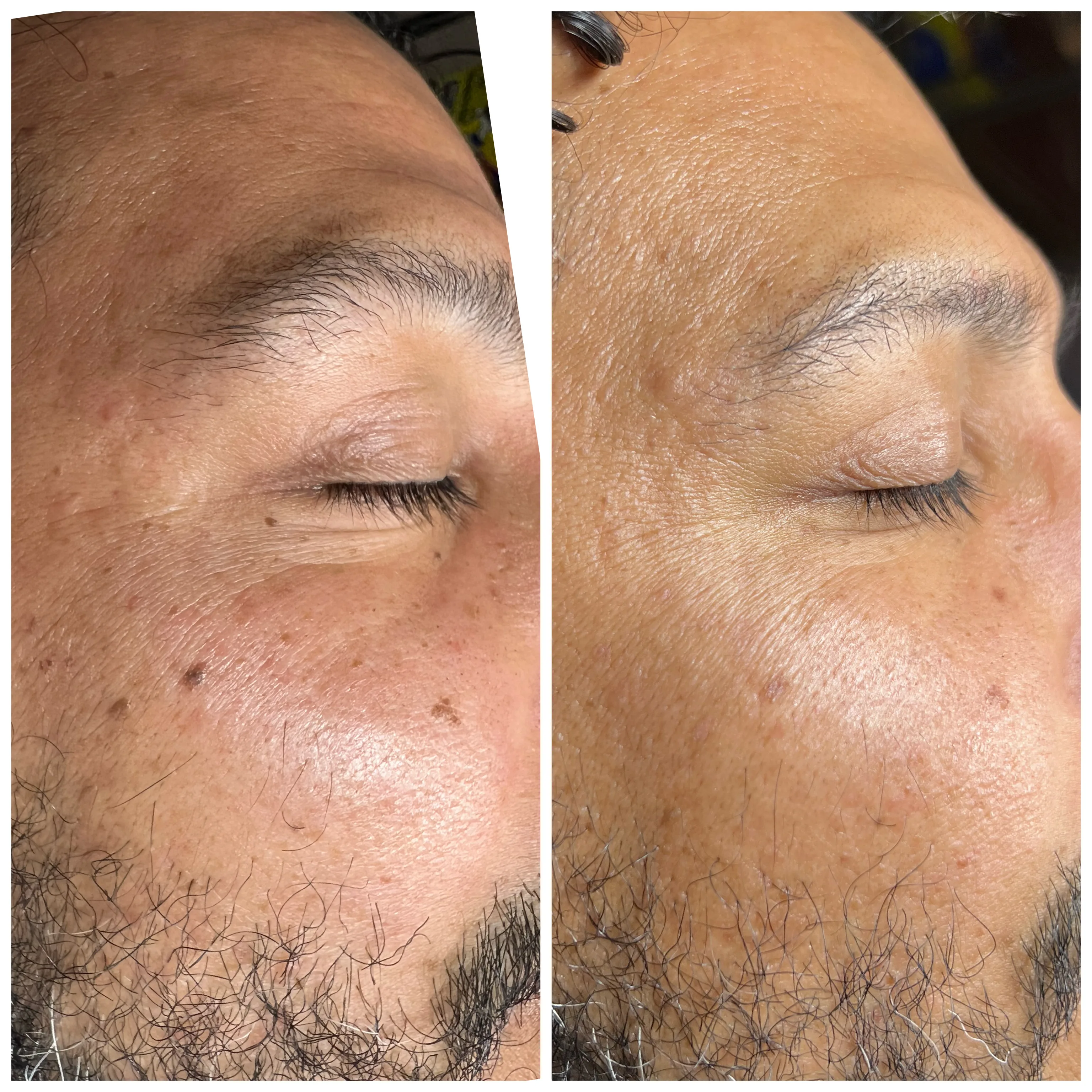 Before and after Skin Sheek treatment results