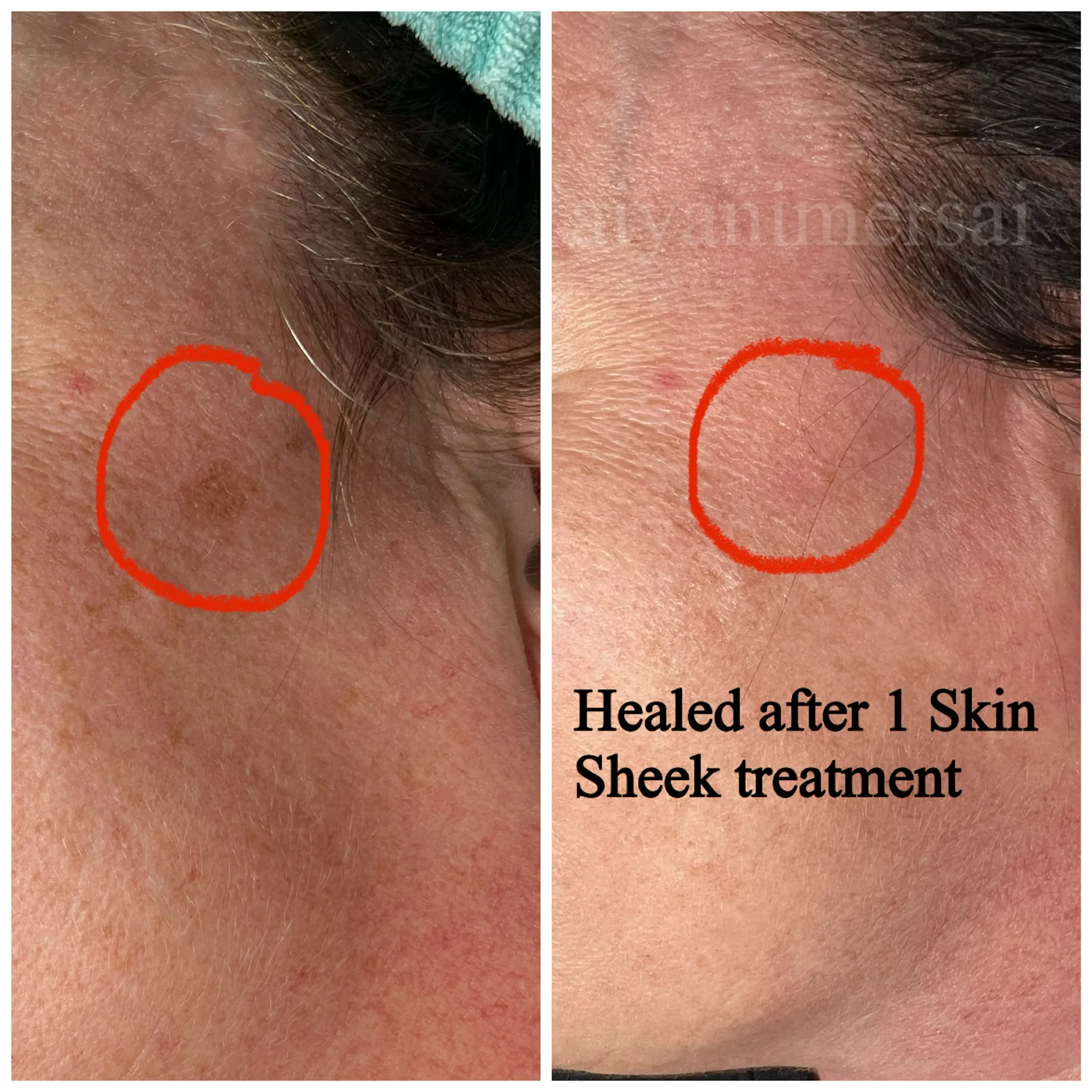 Before and after Skin Sheek treatment results