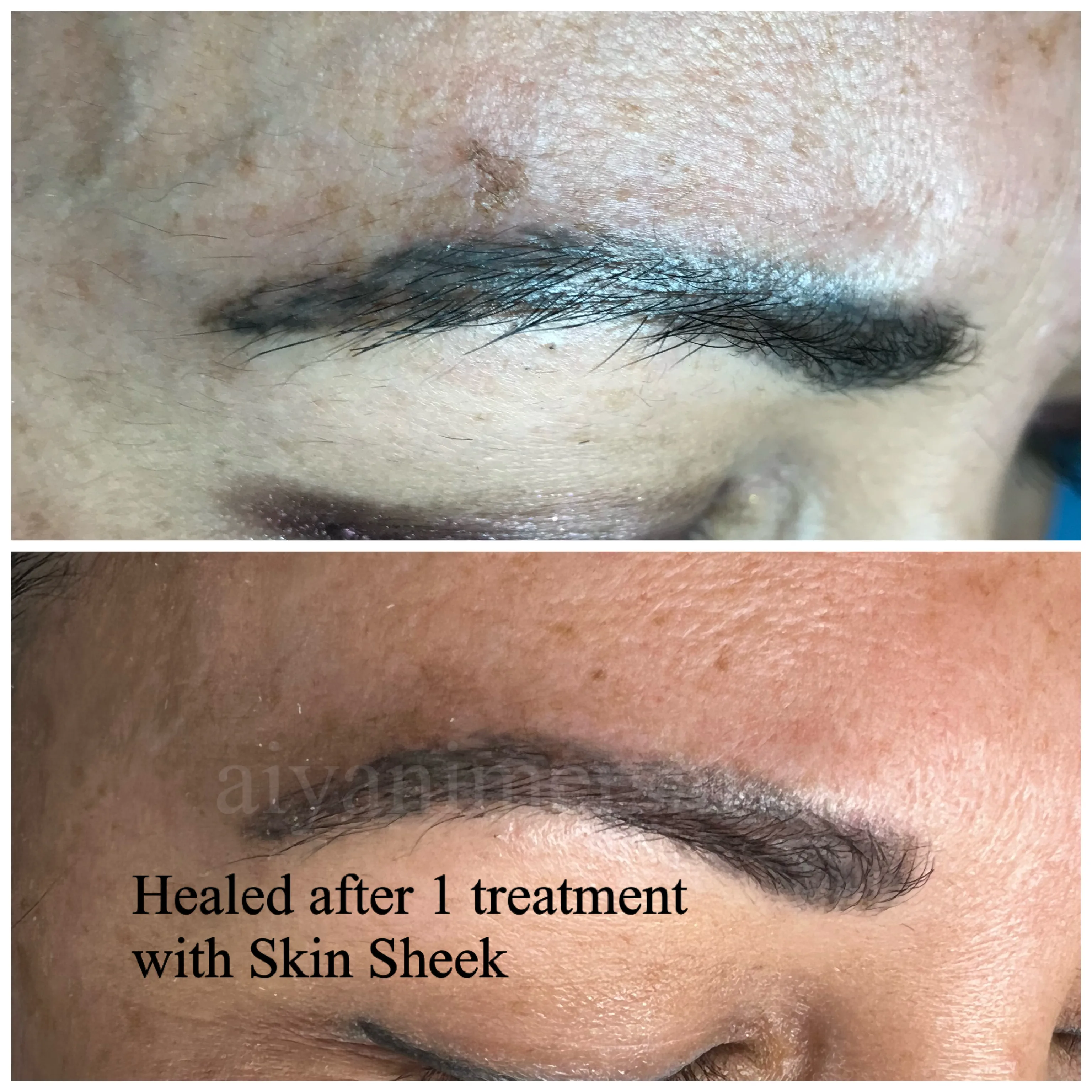 Before and after Skin Sheek treatment results