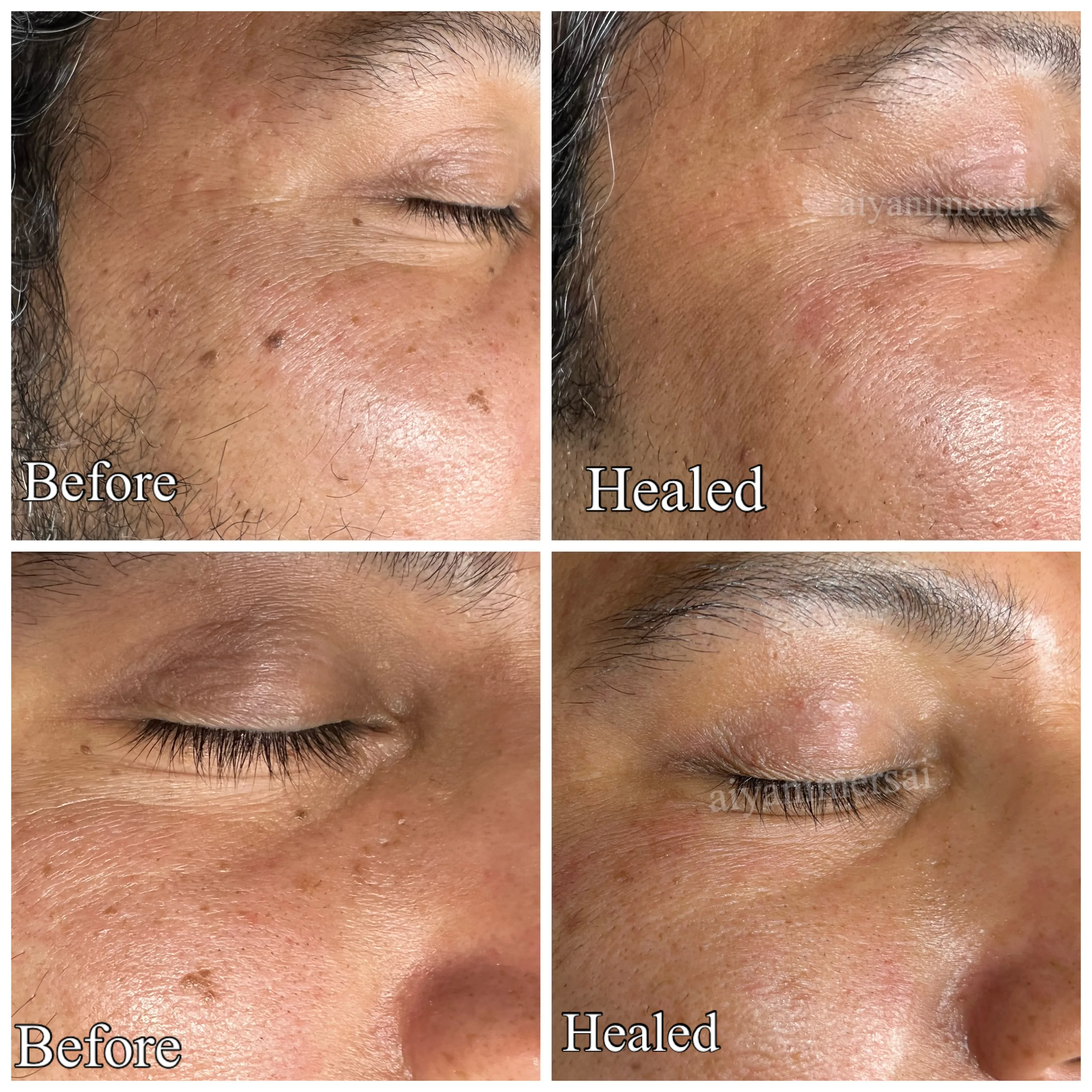 Before and after Skin Sheek treatment results