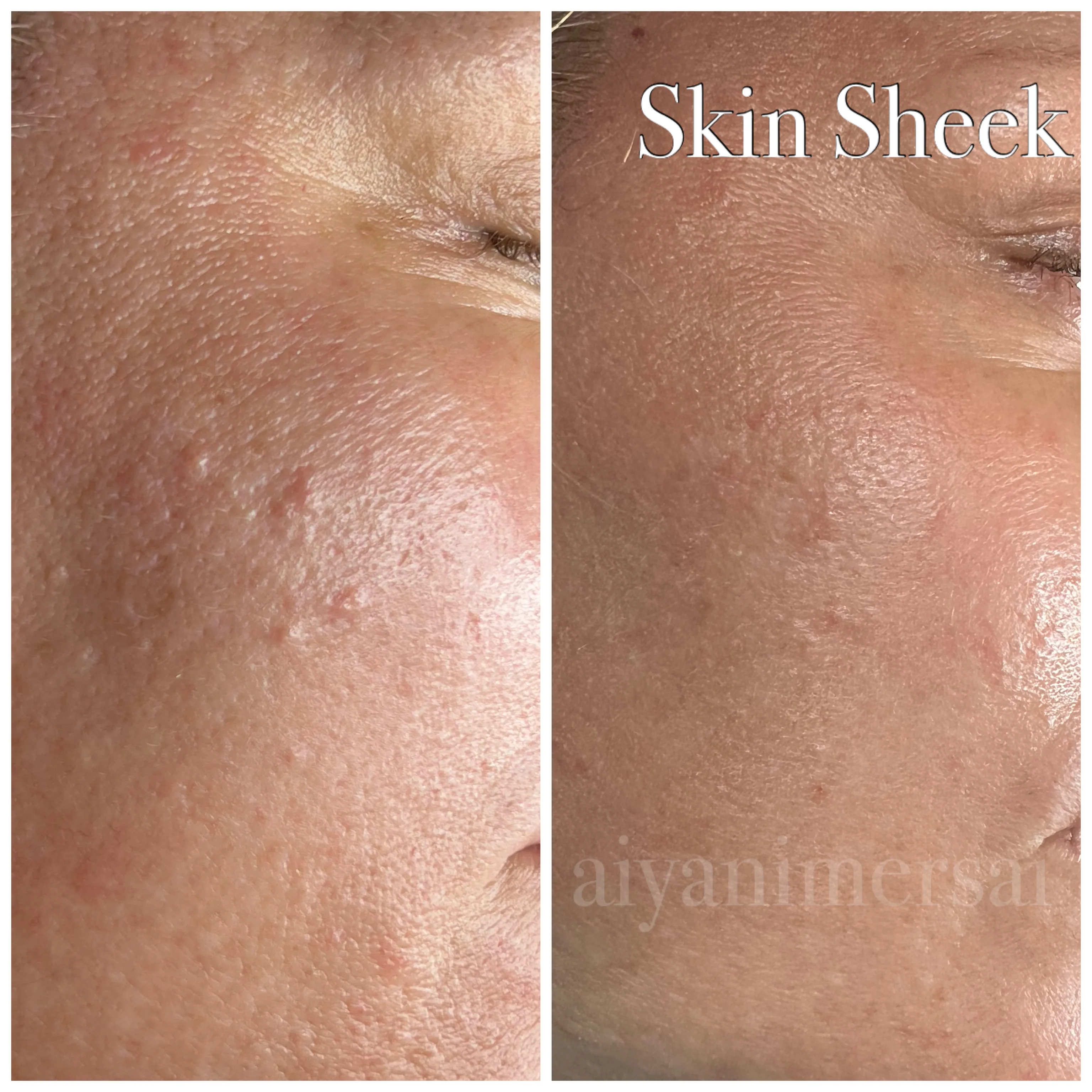 Before and after Skin Sheek treatment results