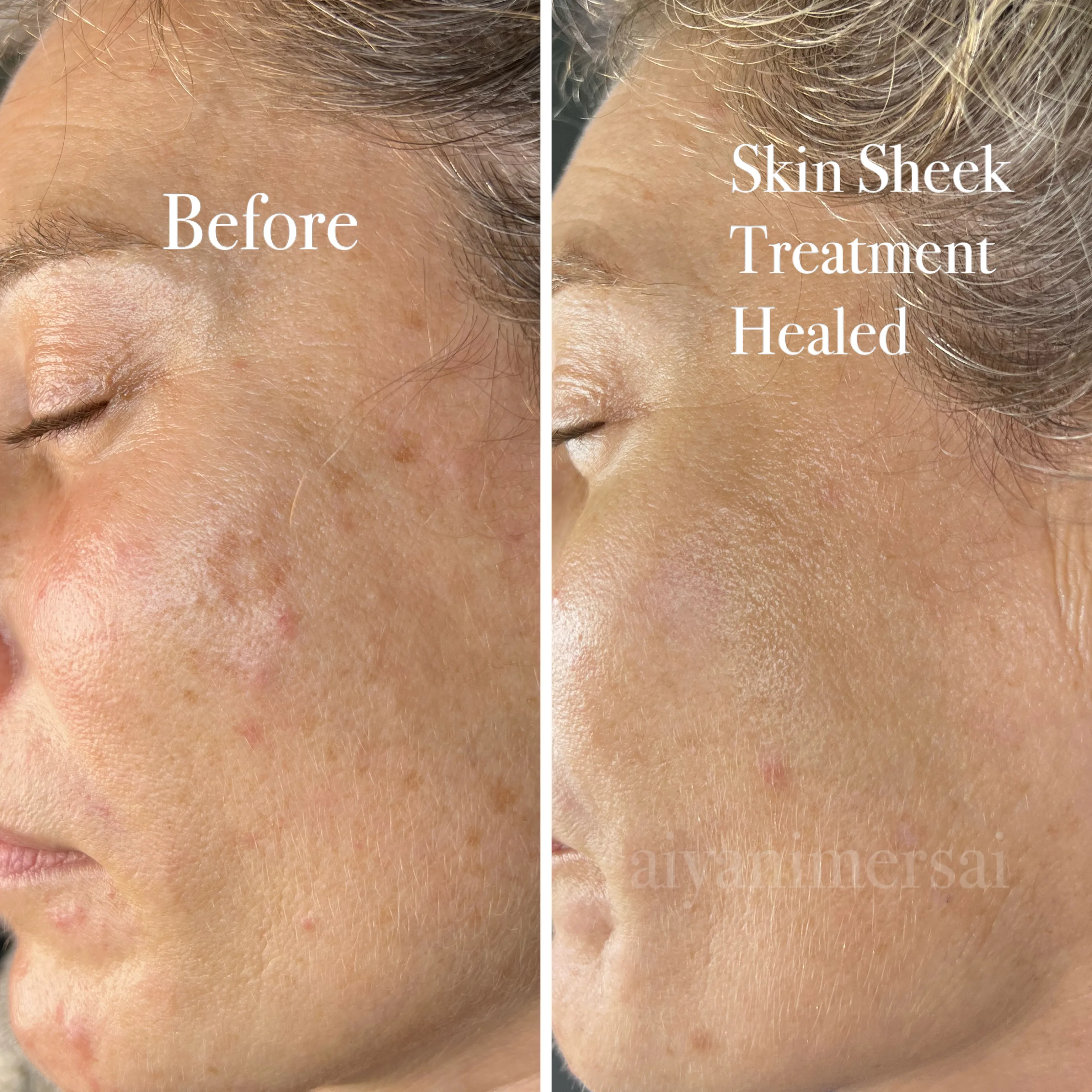 Before and after Skin Sheek treatment results