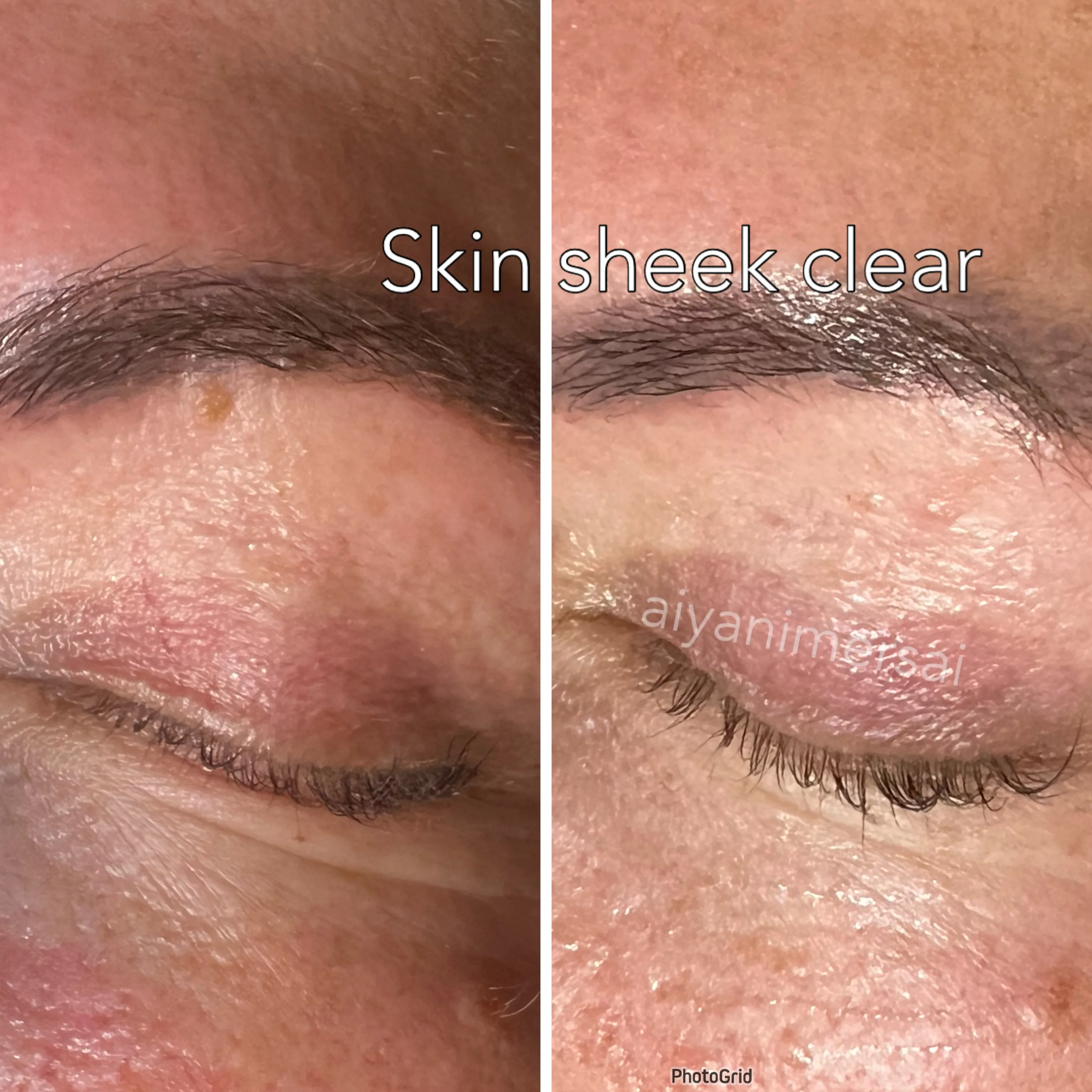 Before and after Skin Sheek treatment results