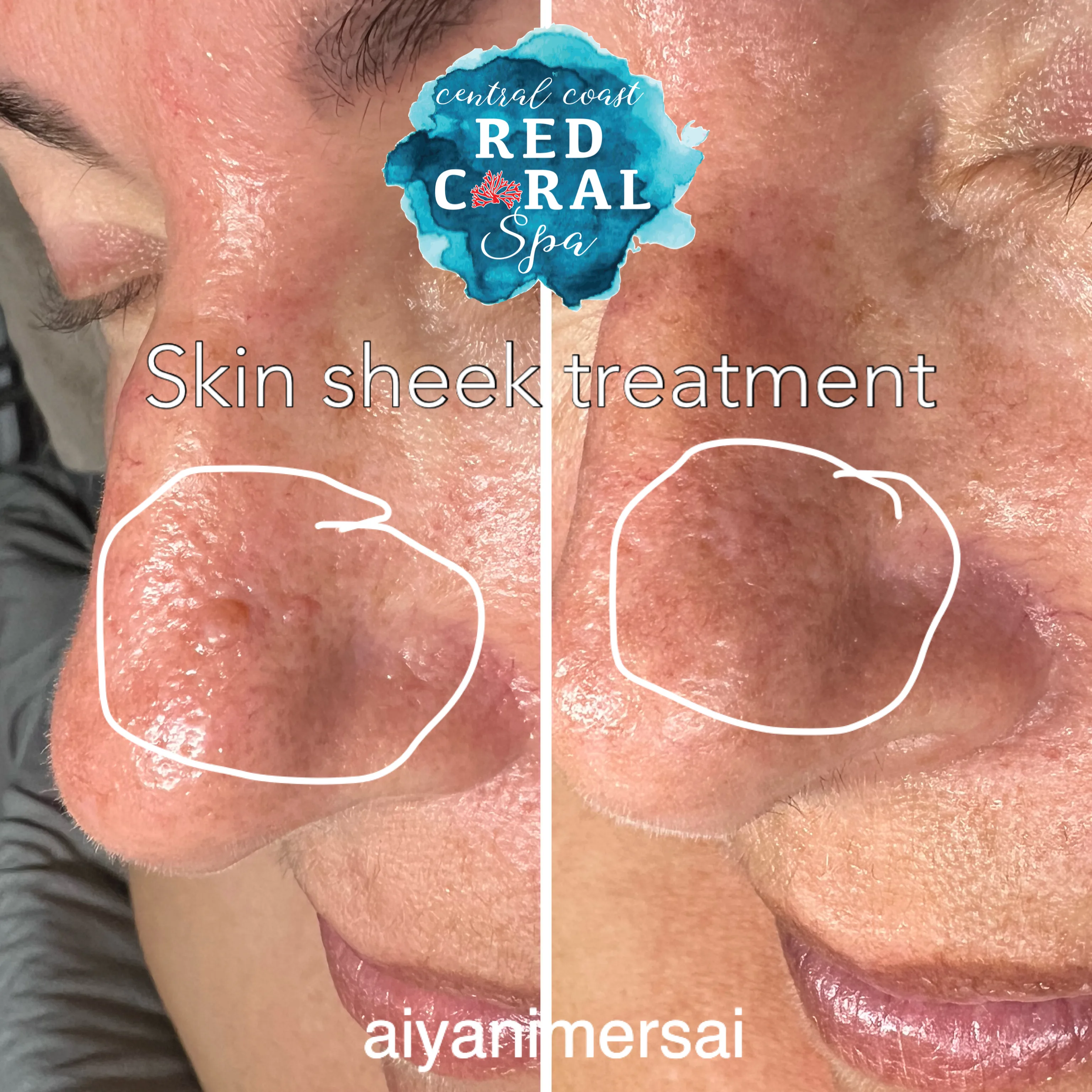 Before and after Skin Sheek treatment results