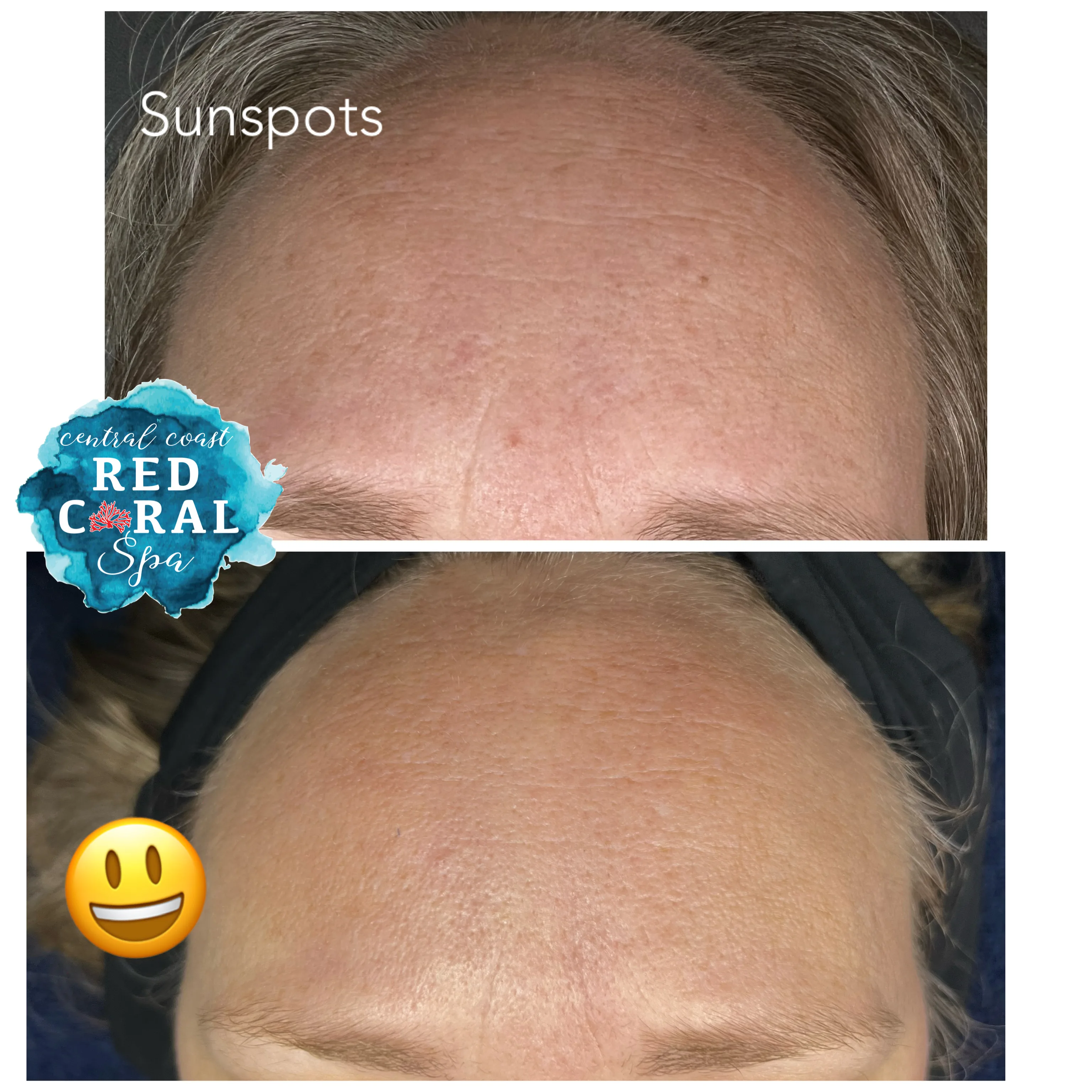 Before and after Skin Sheek treatment results