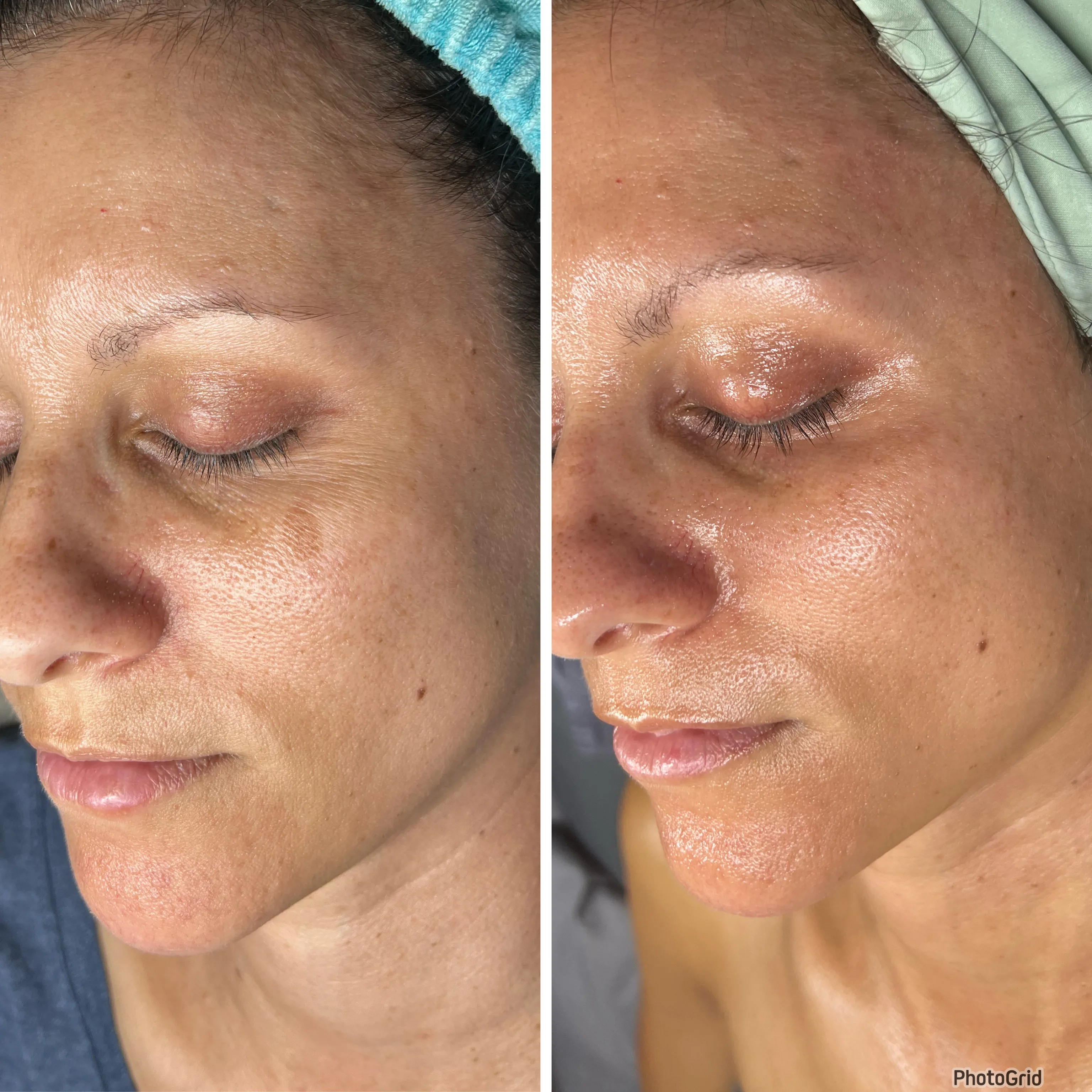 Before and after Skin Sheek treatment results