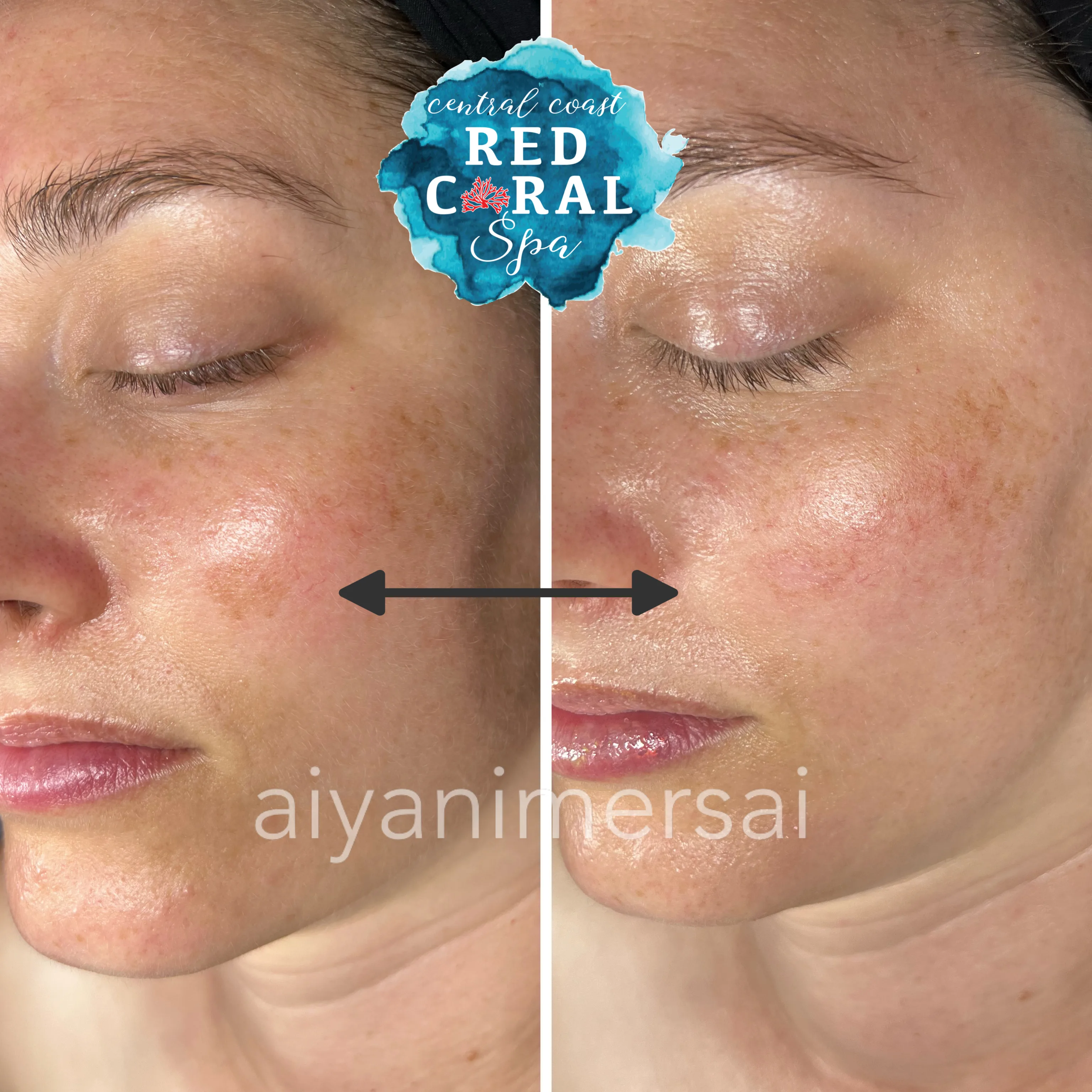 Before and after Skin Sheek treatment results