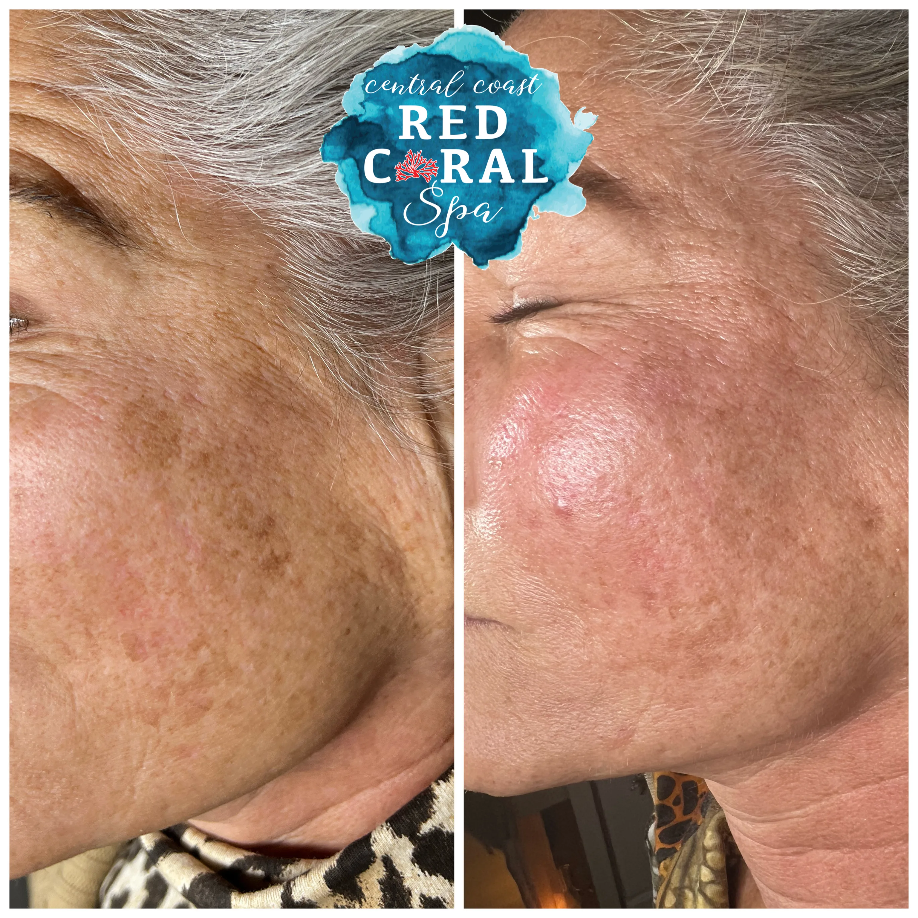 Before and after Skin Sheek treatment results