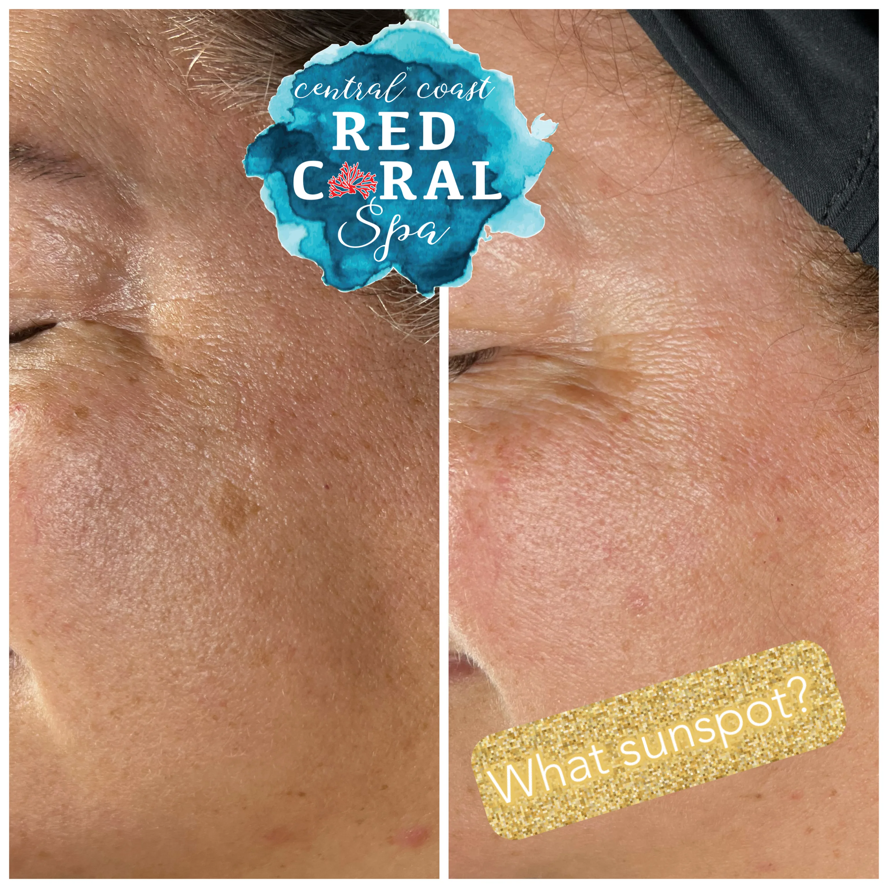 Before and after Skin Sheek treatment results