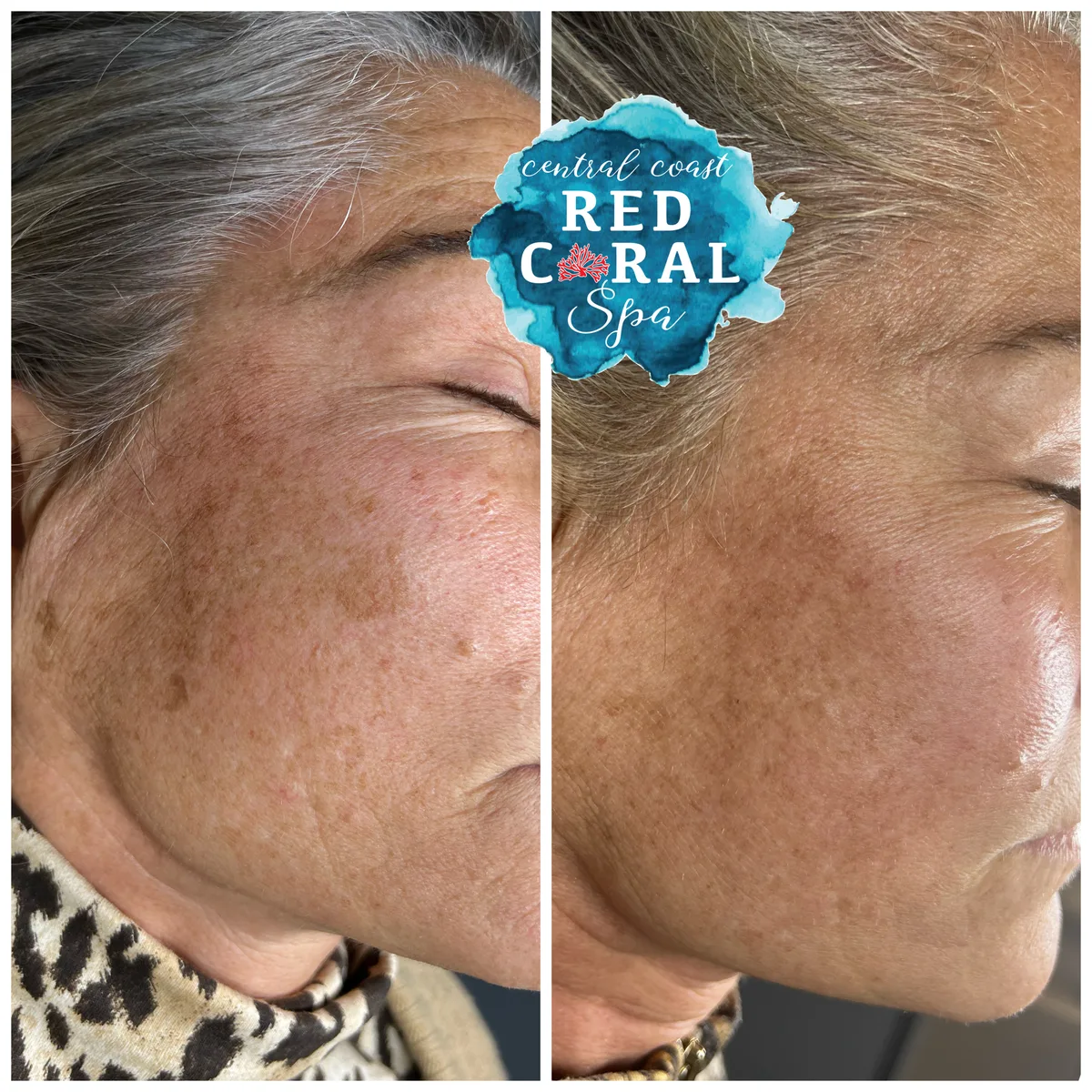 Before and after Skin Sheek treatment — sunspot removal