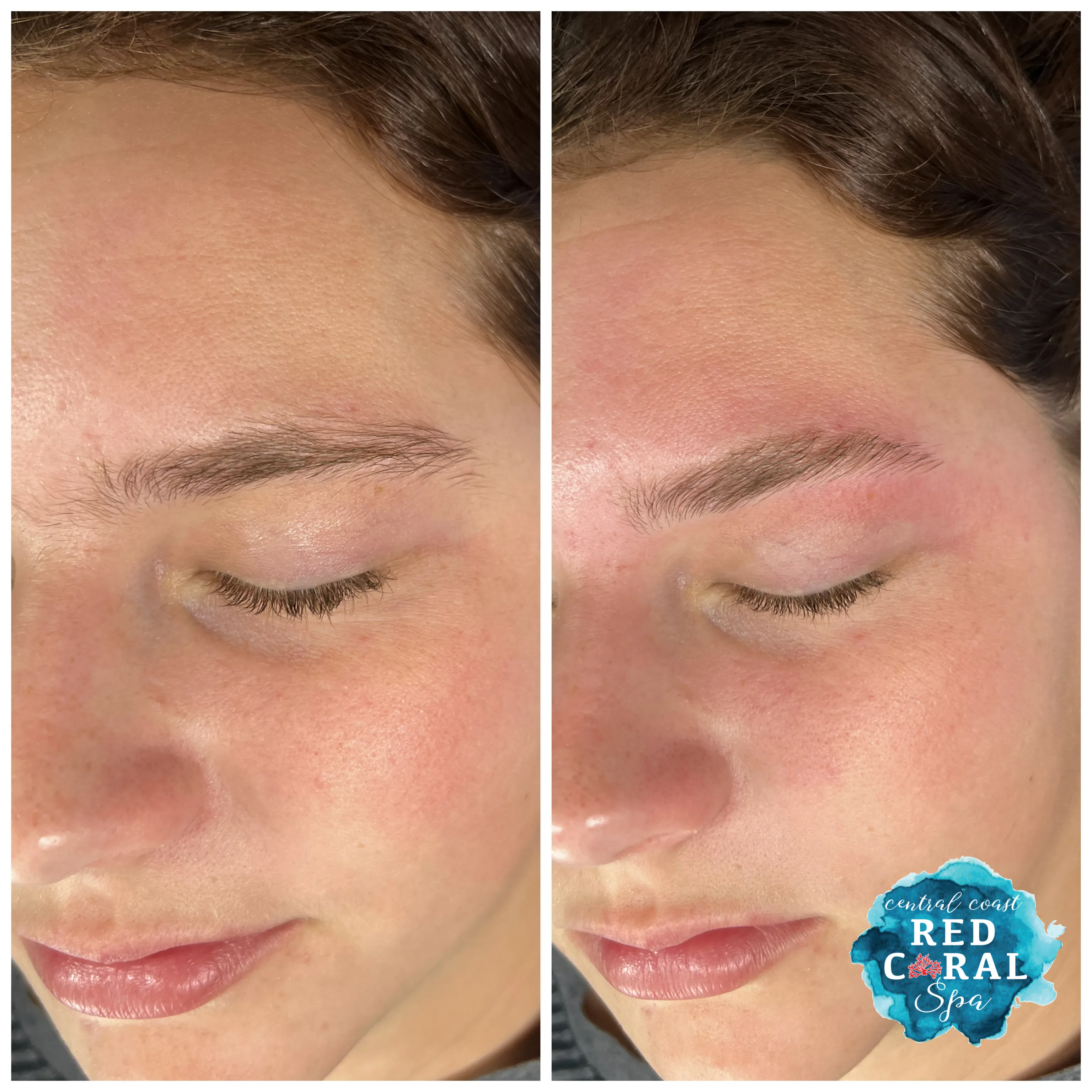 Before and after sugaring hair removal results