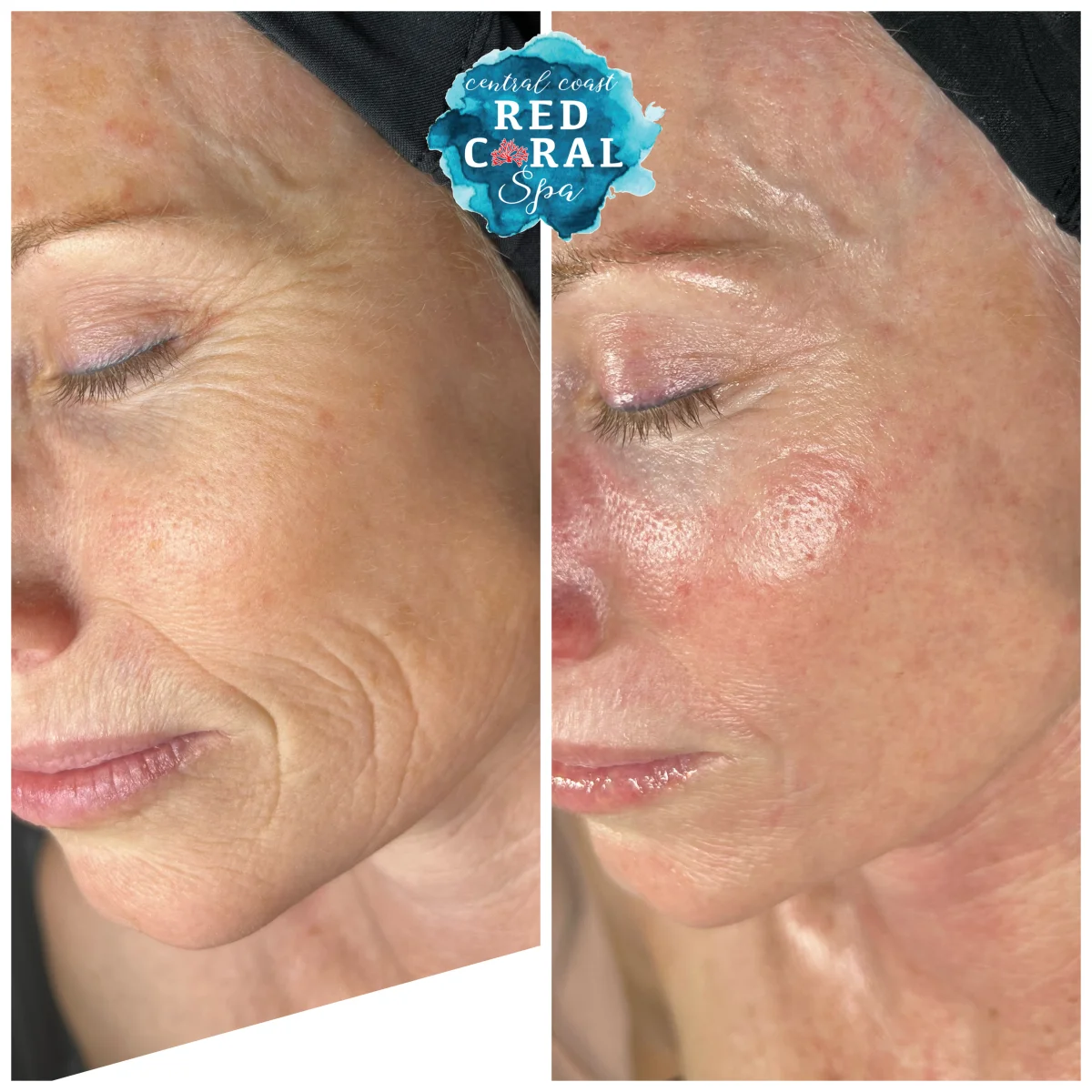 Jenny's before and after results at Central Coast Red Coral Spa